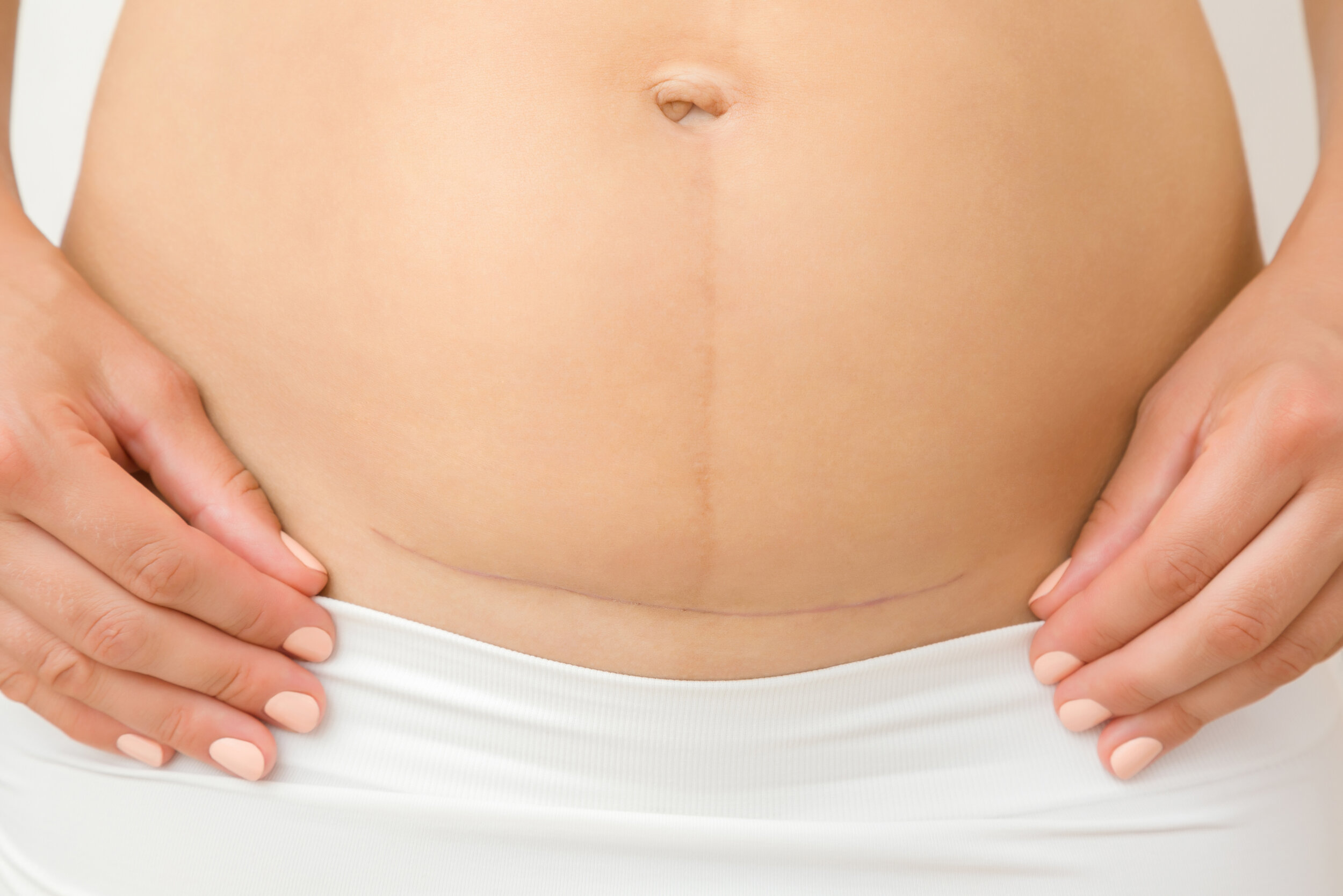 C Section The Impact Of That Scar Surrey Osteopathic Care