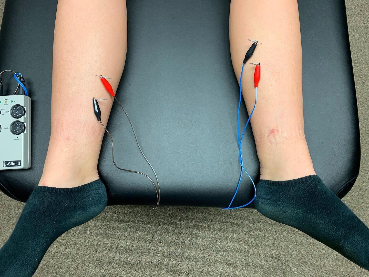 What to do about Shin Splints⁉️

There are two types of shin splints: 
1️⃣Anterior Shin Splints involving the the Anterior Tibialis Muscle 
2️⃣ Posterior Shin Splints invoking the Posterior Tibialis muscle 

Signs/Symptoms:
Sharp pain in the front or