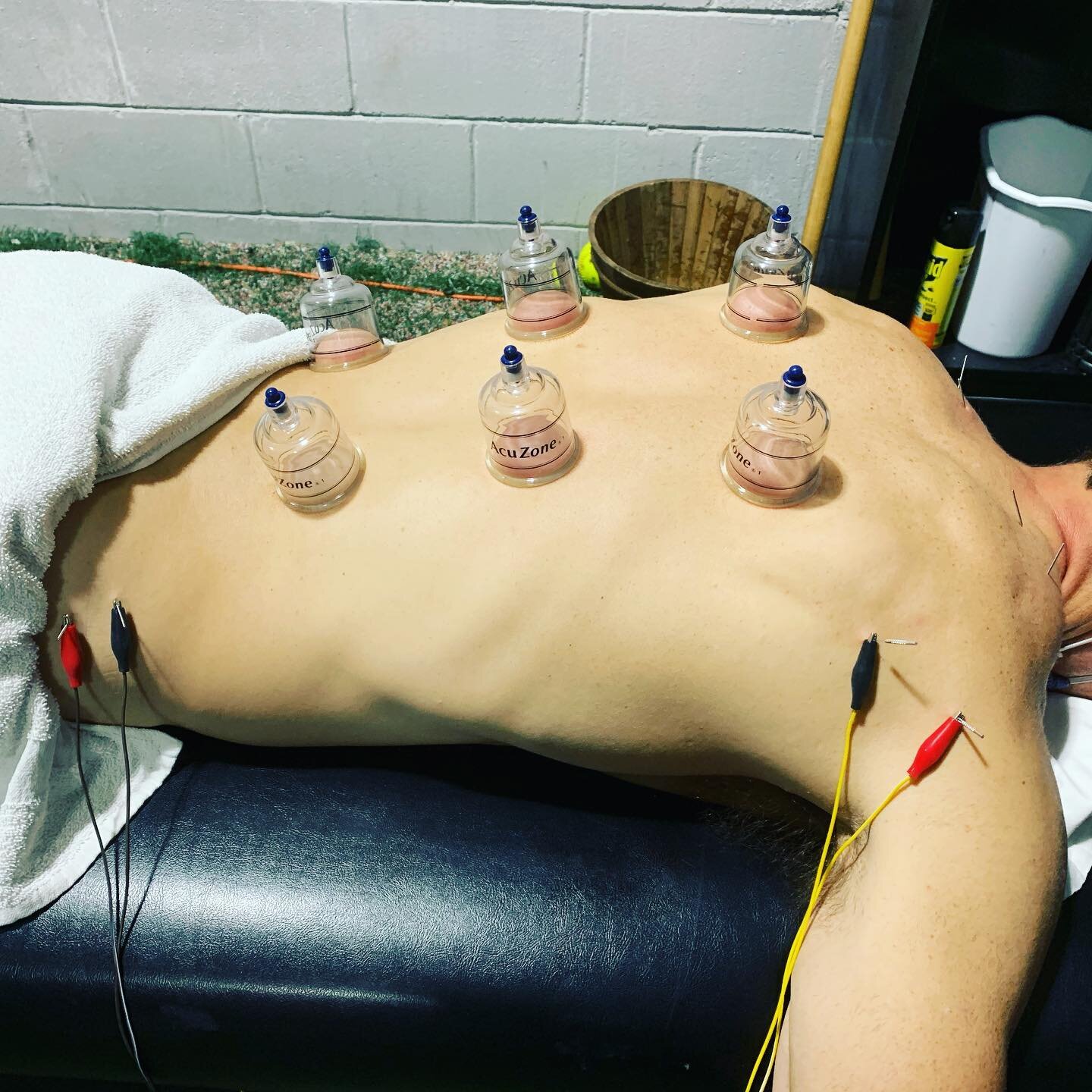 Doing a combination of cupping and trigger point dry needling to release trigger points and fascial tension in this client. 

Both of these techniques are used to treat pain; whether is it shoulder, low back, knee pain etc. 

We follow these techniqu