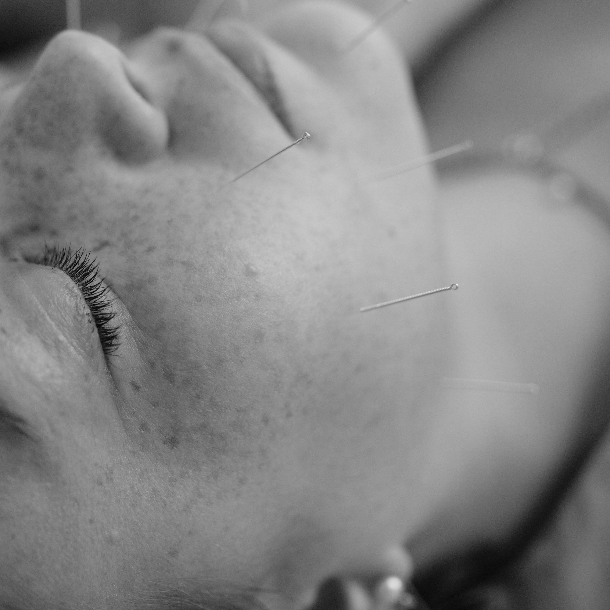 Traditional vs Modern facial acupuncture: which one is best suited for you.