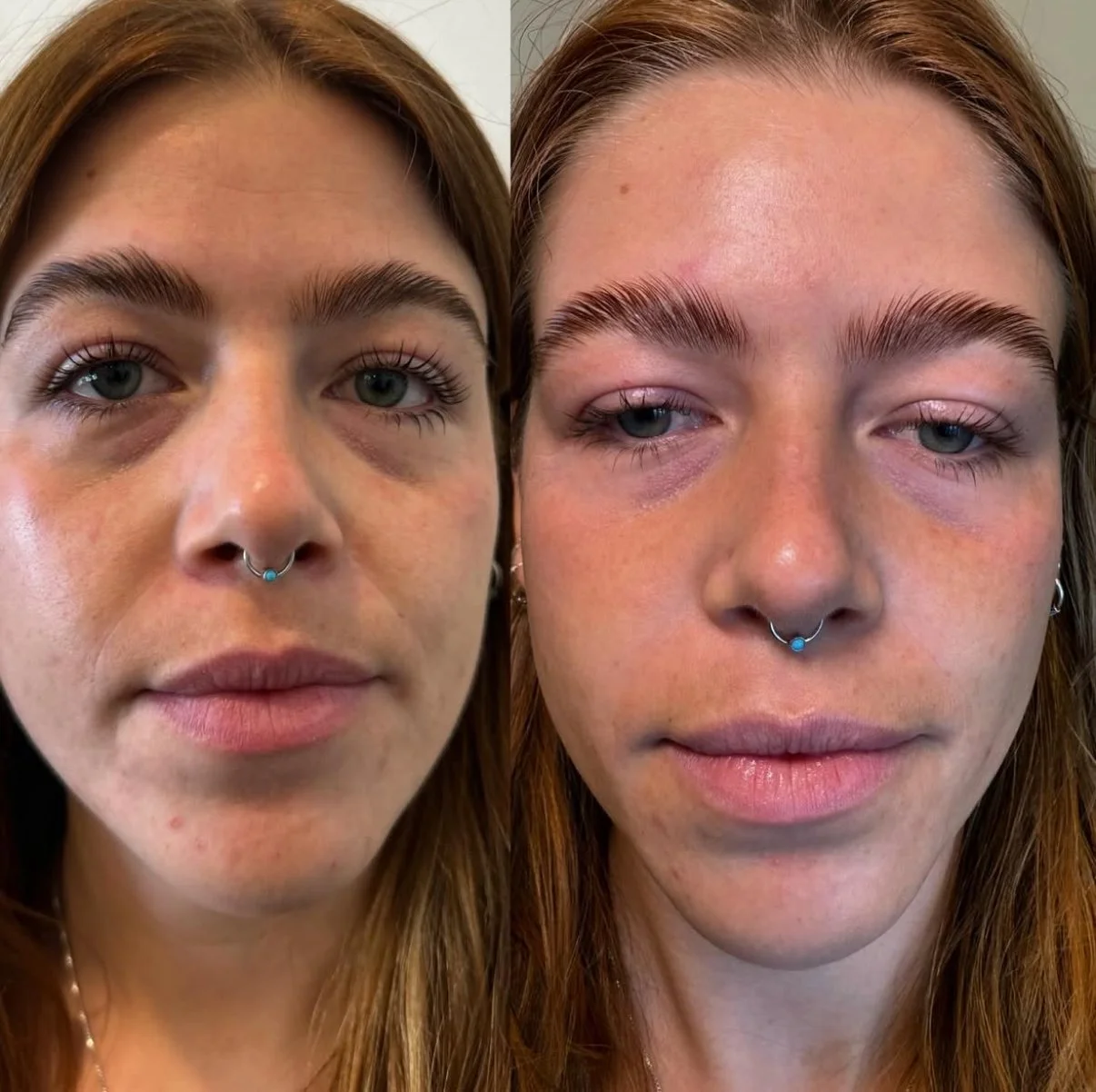 PRP Facial & Scalp Injections: The Natural Glow & Hair Regrowth Solution