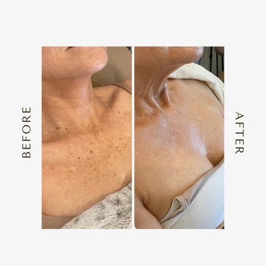 before and after of decolette in Park city