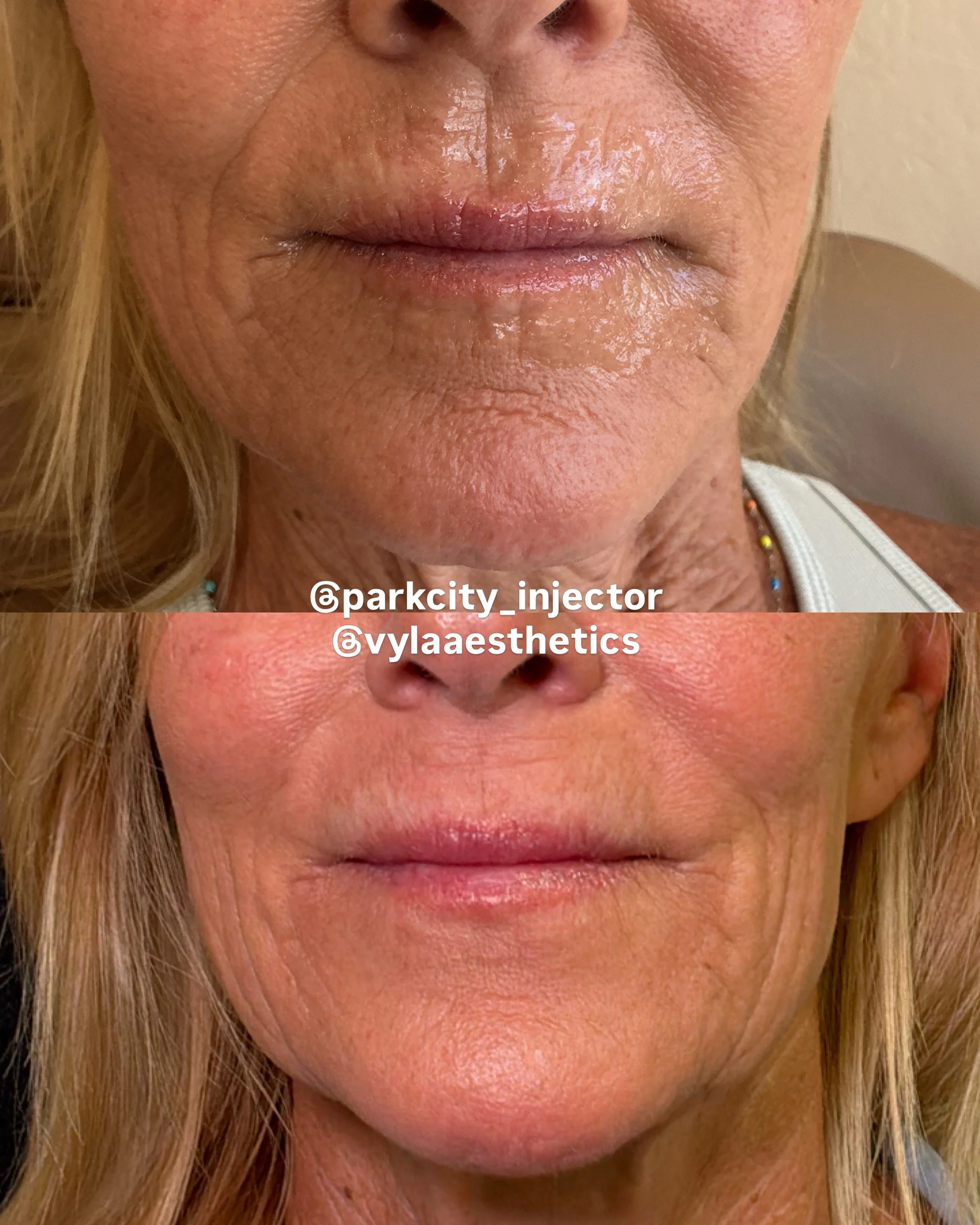 perioral filler before and after