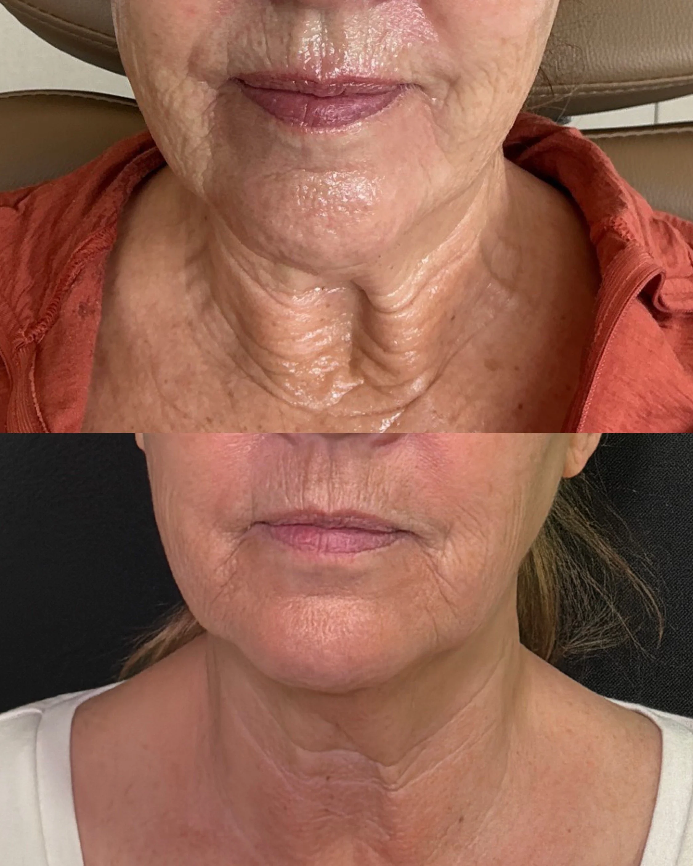 before and after ultra clear laser treatment