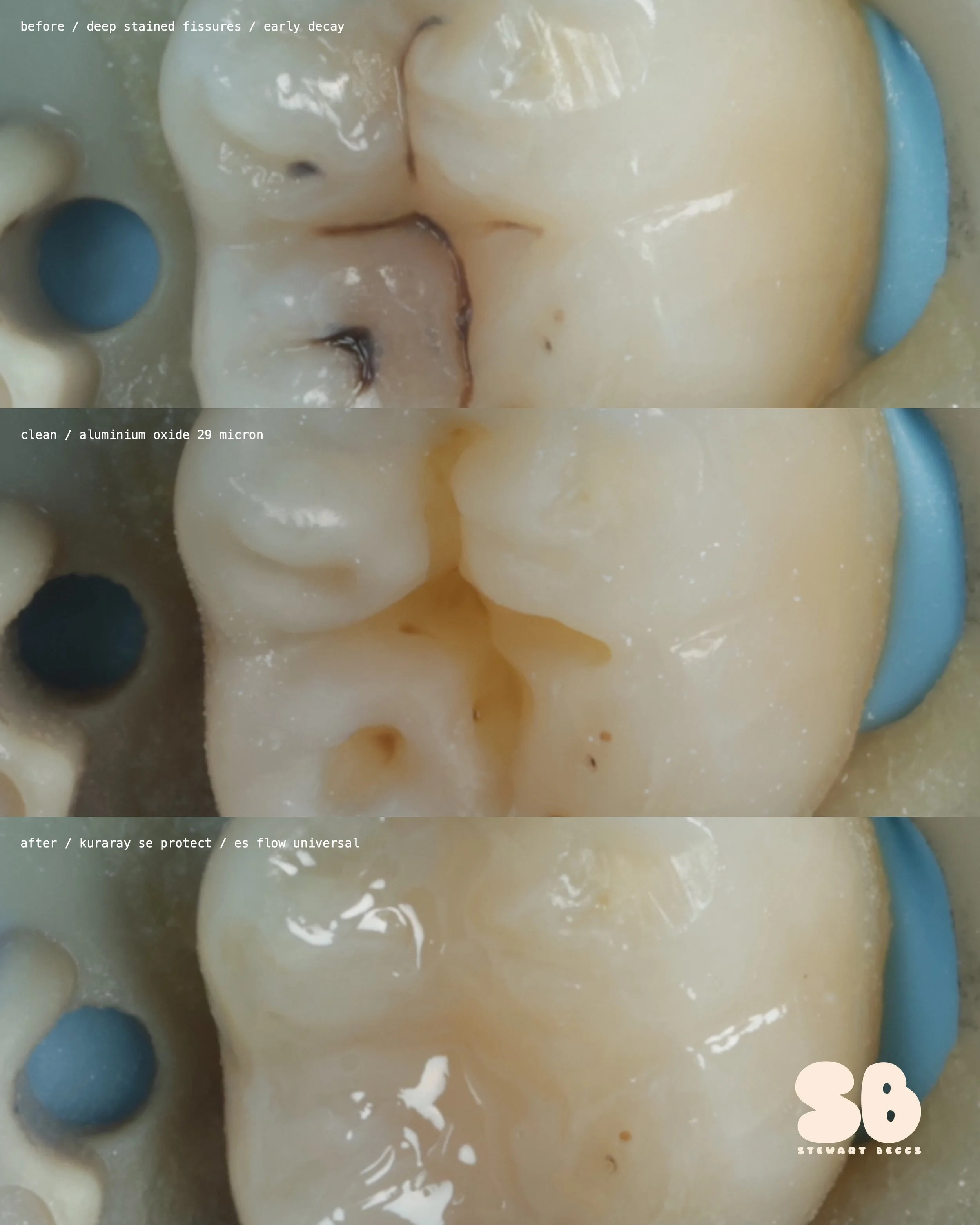 Fissure Sealant 