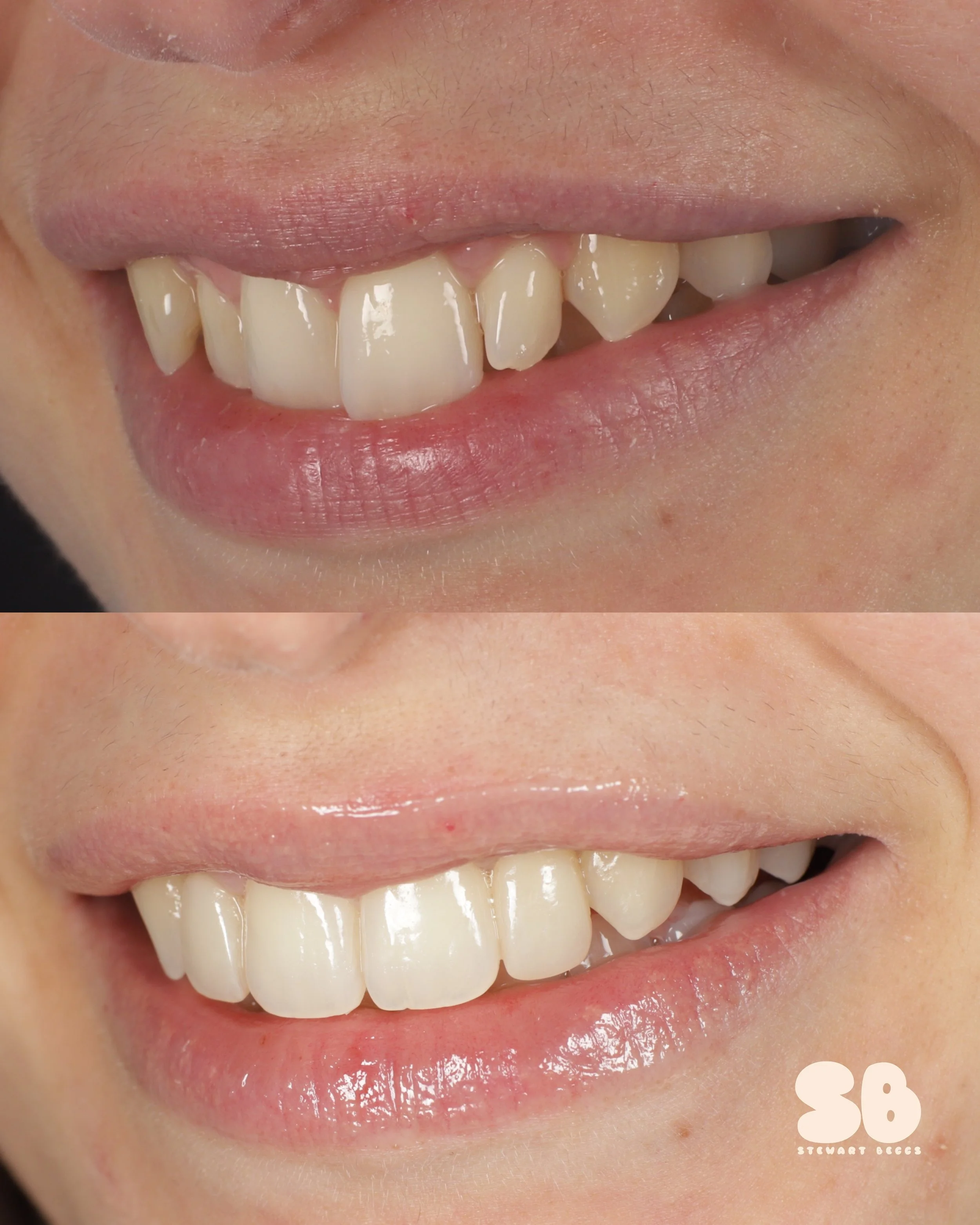 Aligners and Composite Bonding (2 Teeth)