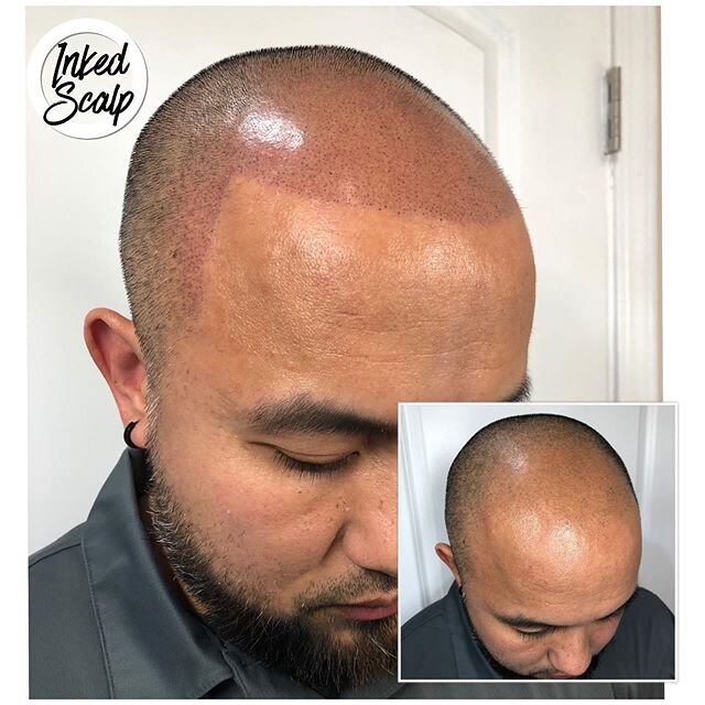 Scalp Pigmentations/ Hairline Tattoo @inked_scalp ___________________________________________ 👈🏻 SWIPE LEFT TO SEE HEALED RESULTS 🤩 🤩🤩
___________________________________________

Scalp Micropigmentation is the fastest and most affordable way fo
