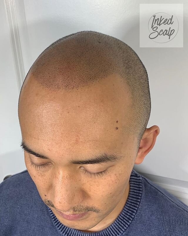We&rsquo;re having a promotion for scalp pigmentations for men and women and offering 50% discount for the first session! 🥳🤩
___________________________________________

The Scalp Micropigmentation treatment typically takes 2-4 hours per session de