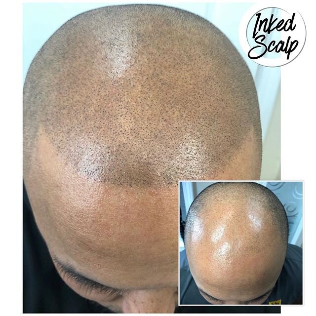 Up close and personal 🤩. What a transformation!! Get your new Hair line for 2020 🎊🍾🔥 &mdash;&mdash;&mdash;&mdash;&mdash;&mdash;&mdash;&mdash;&mdash;&mdash;&mdash;&mdash;&mdash;&mdash;&mdash;&mdash;&mdash;&mdash;&mdash;&mdash;-Scalp Micropigmentat