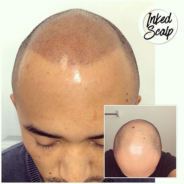 No hat needed anymore with this hairline. Build your confidence and live happier . I can help 🙋&zwj;♂️🤙✍️✍️&mdash;&mdash;&mdash;&mdash;&mdash;&mdash;&mdash;&mdash;&mdash;&mdash;&mdash;&mdash;&mdash;&mdash;&mdash;&mdash;&mdash;&mdash;&mdash;&mdash;&