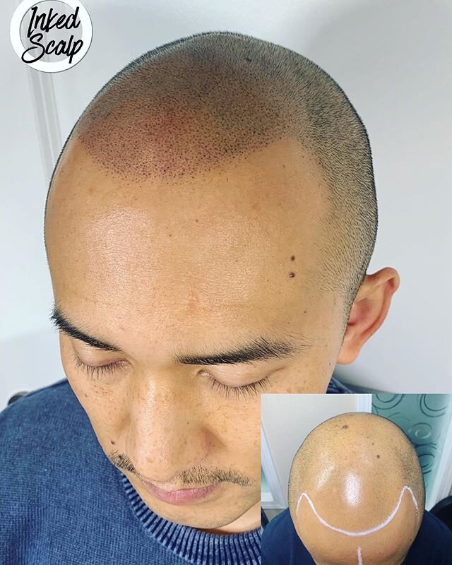 From 0️⃣to 💯real quick.. SMP is the fastest way to restore your hair line without any surgery or implant. By mimicking your hair follicles gives you the look of fuller hair either you are bald or having thin hair ✍️🤙 &mdash;&mdash;&mdash;&mdash;&md