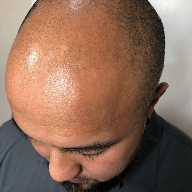 Swipe to see transformation 👉....only 3 treatment sessions and he gets his hair line back 🤩🤙✍️&mdash;&mdash;&mdash;&mdash;&mdash;&mdash;&mdash;&mdash;&mdash;&mdash;&mdash;&mdash;&mdash;&mdash;&mdash;&mdash;&mdash;- get your hair line restore after