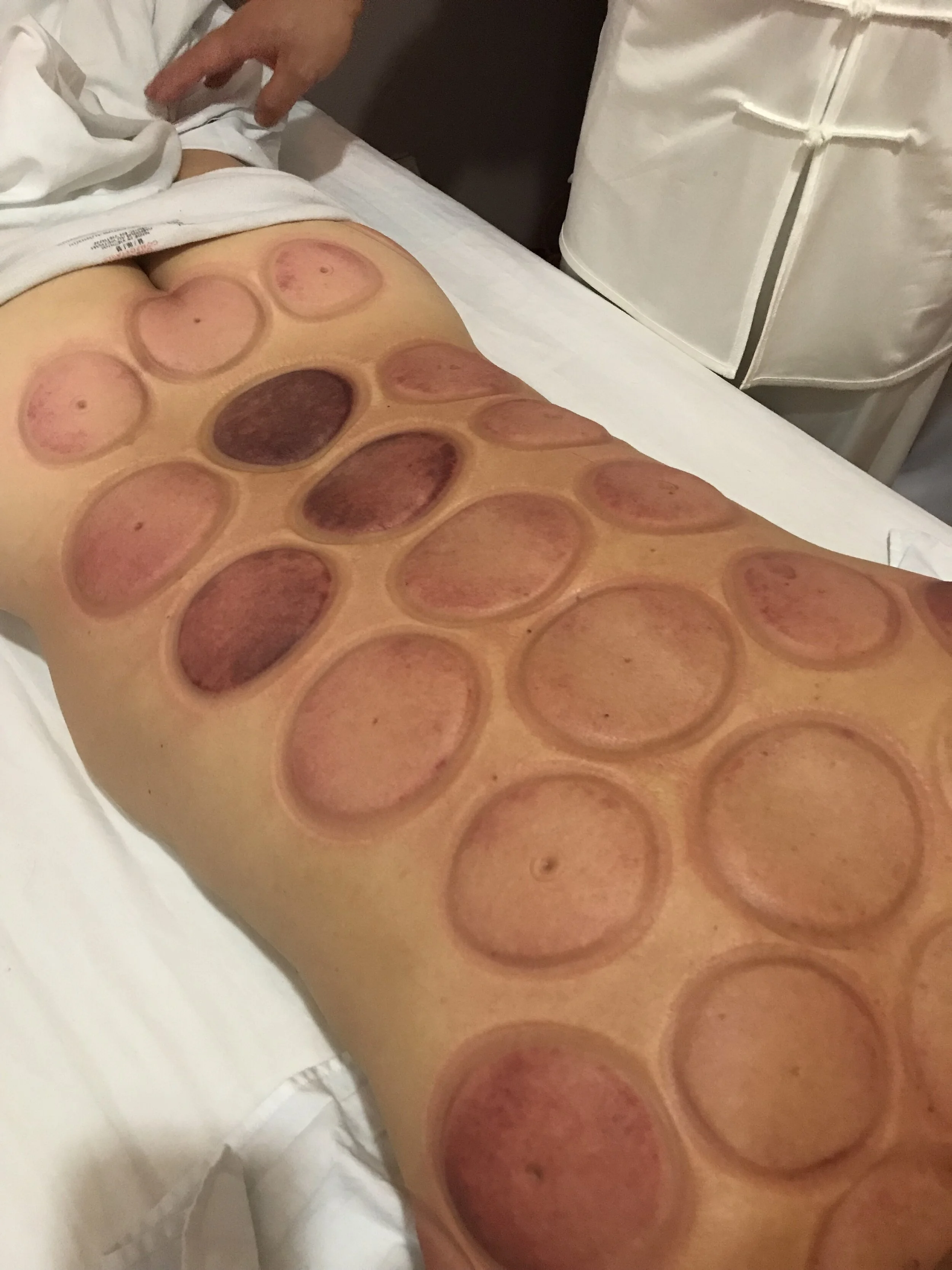 Cupping (Copy)