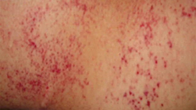 642x361_Slide_1_Petechiae.jpg