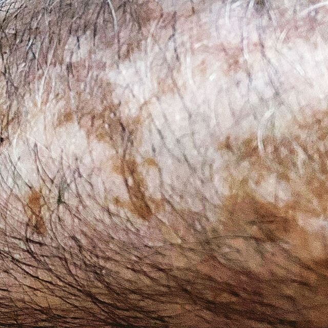 Today is world vitiligo day. An autoimmune disease that affects the colour of the skin, turns you whiter and lowers your natural defence against the sun. I have been dealing with it for many years and I know how hard it is, specially in the summer. T