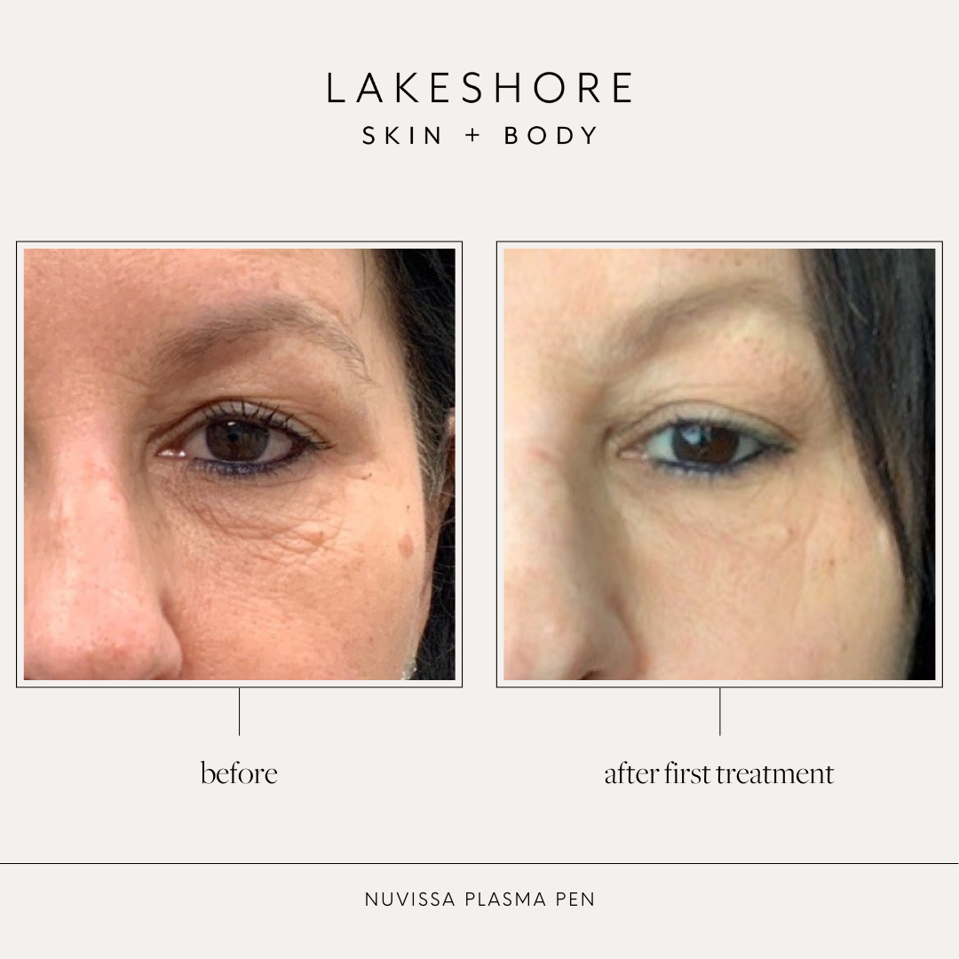 Plasma Pen in Marquette — Best Medspa in Upper Michigan Lakeshore