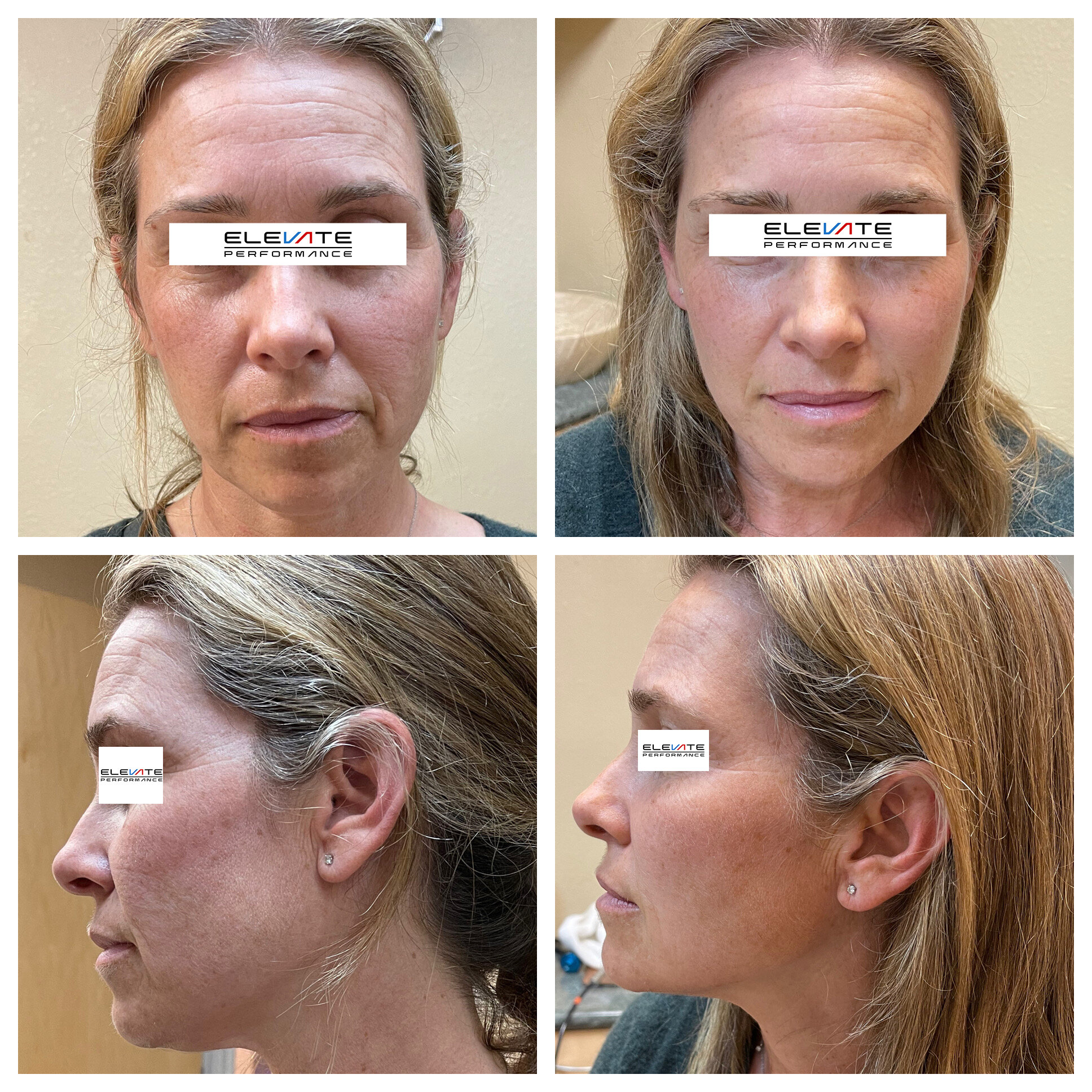 Cryo Facial Before and After — Elevate Performance