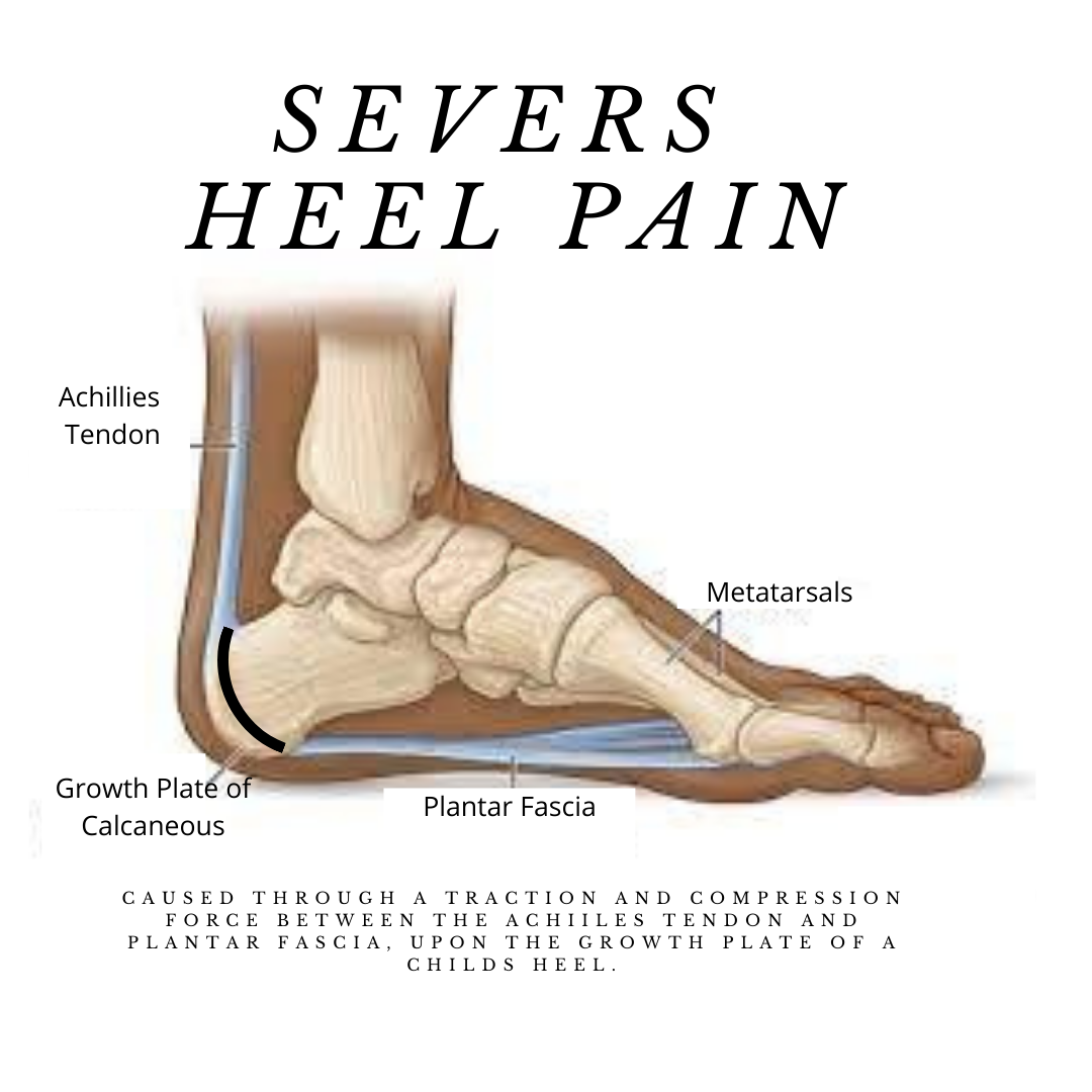 Experiencing foot and heel pain? It could be Plantar Fasciitis.