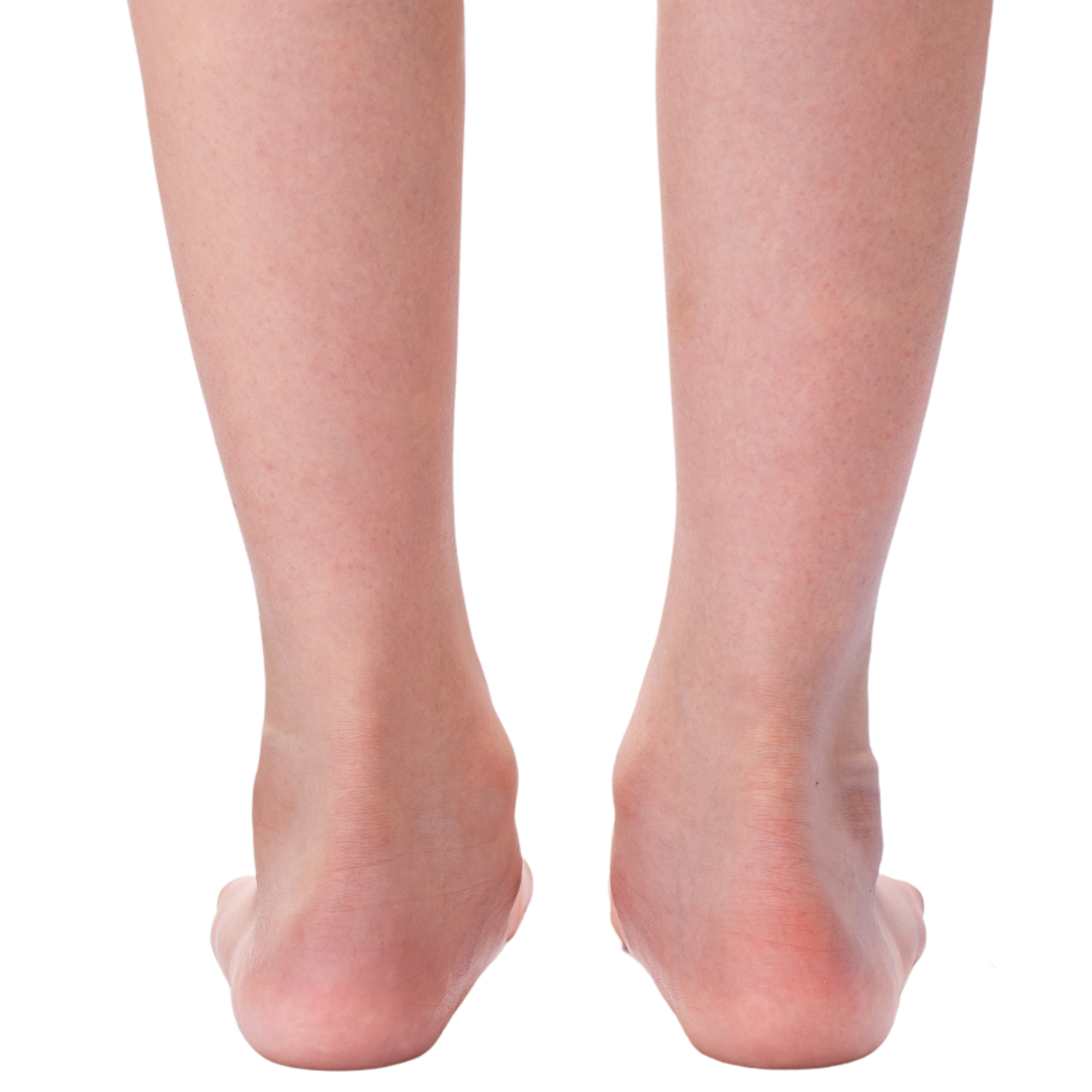 Flat Feet — Kidzoles Orthotics for Kids