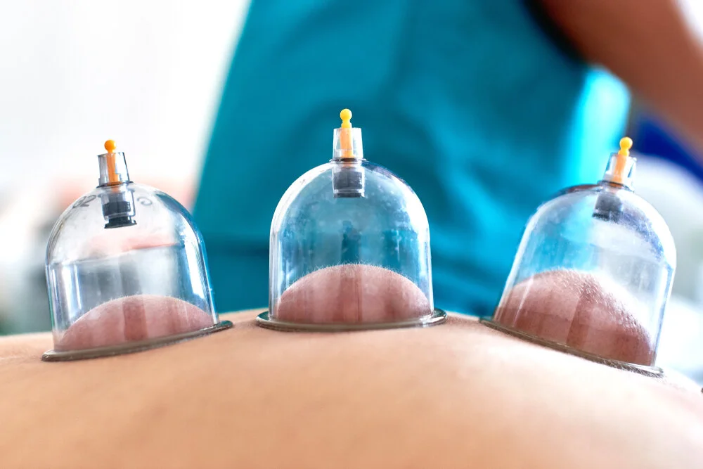 The Benefits of Cupping
