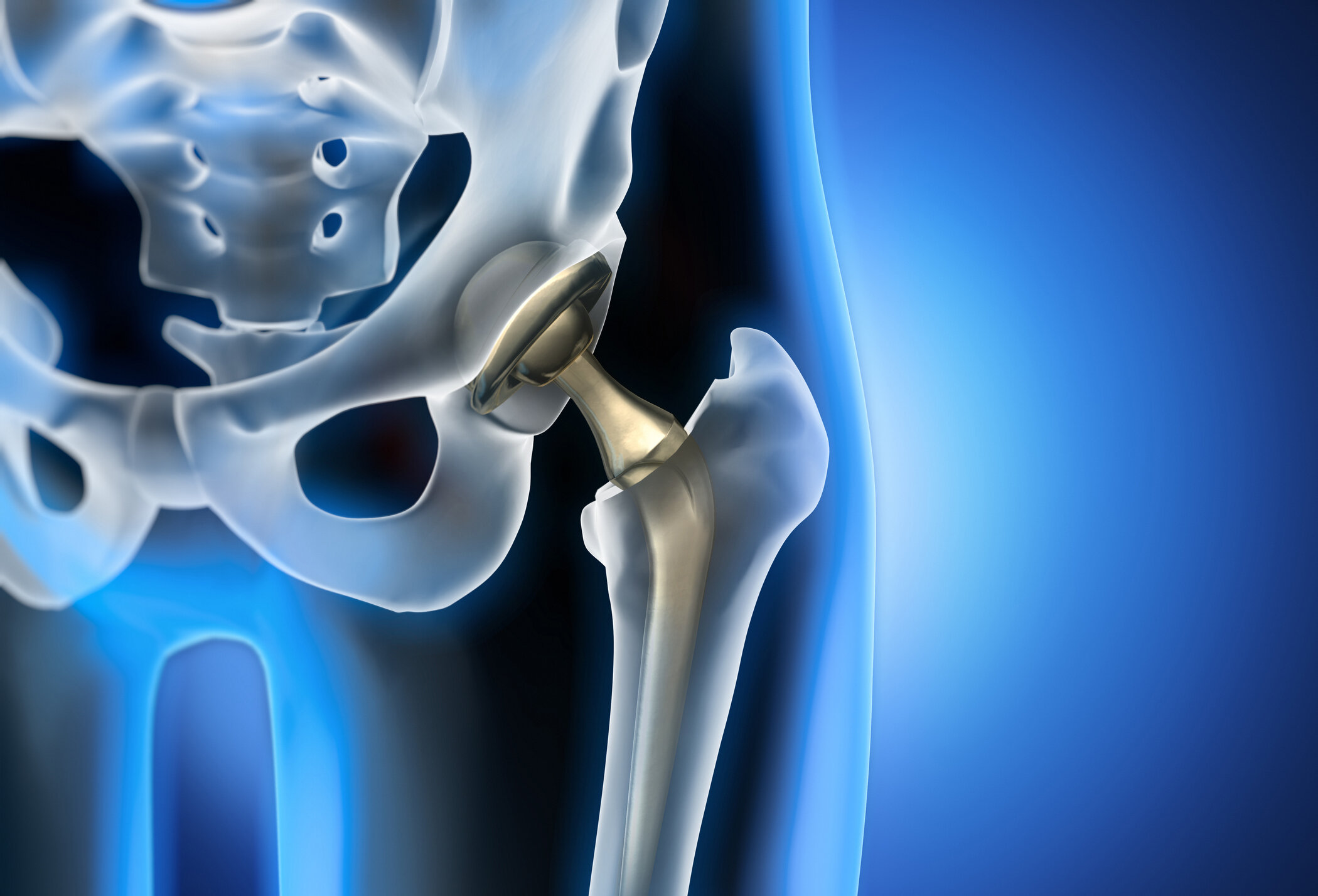 What is involved with Partial Hip Replacement Recovery?