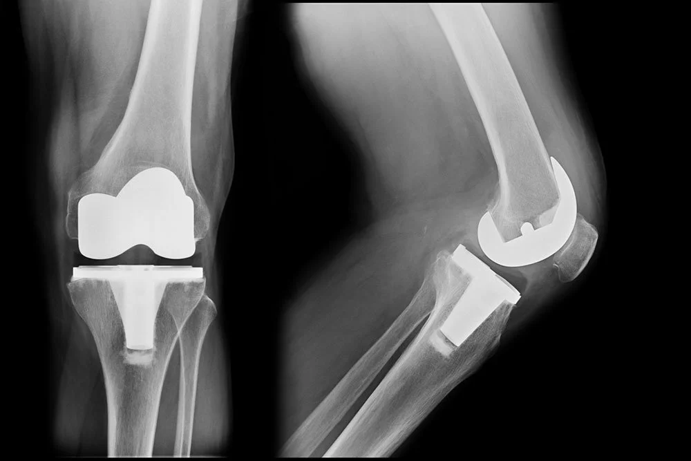Cemented vs Cementless Joint Replacements What Patients Should Know