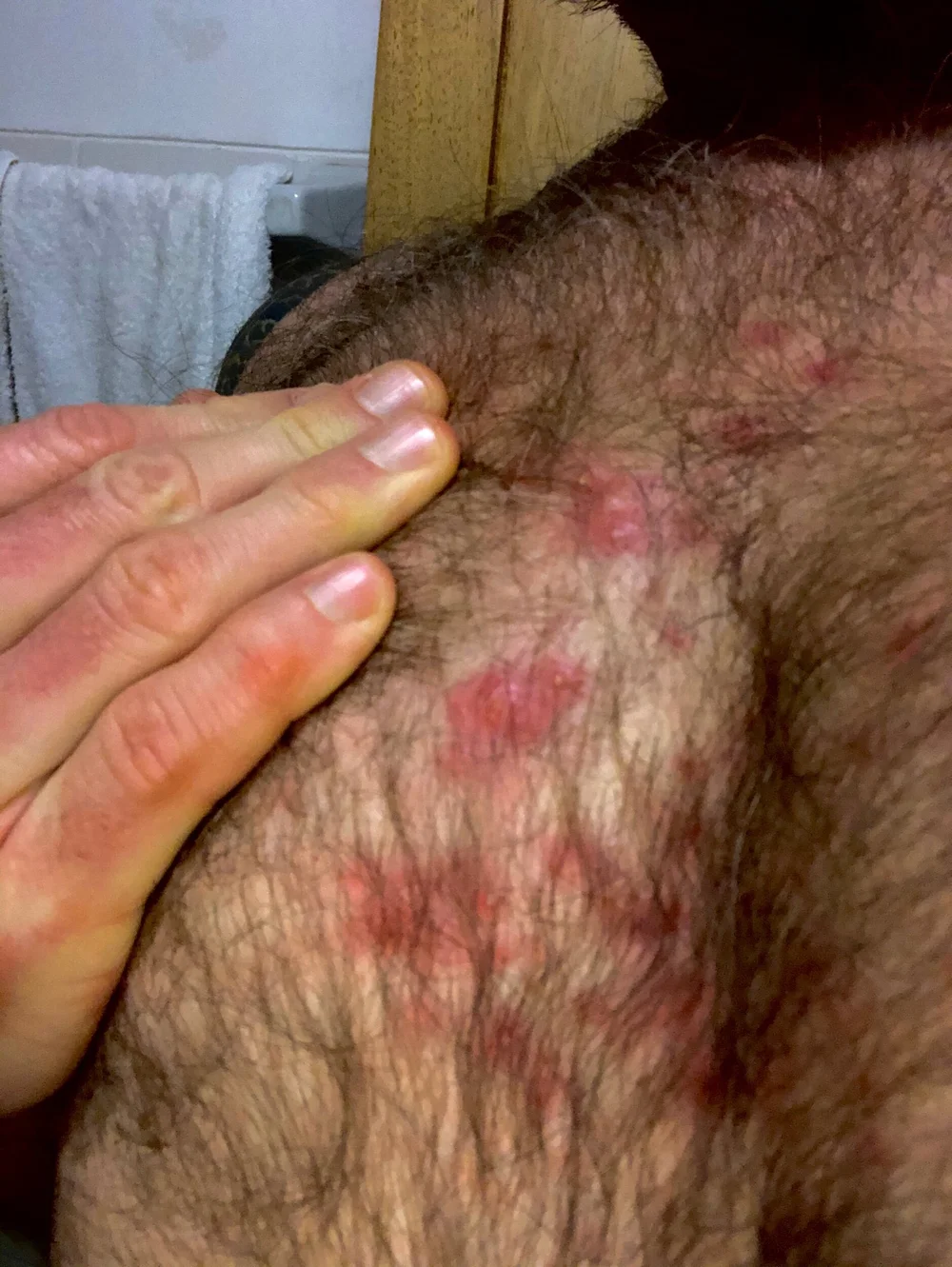  Inflamed skin on chest. Taken July 2020 
