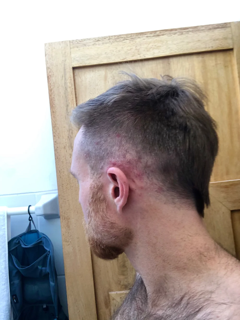  Inflamed behind ears. July 2020 