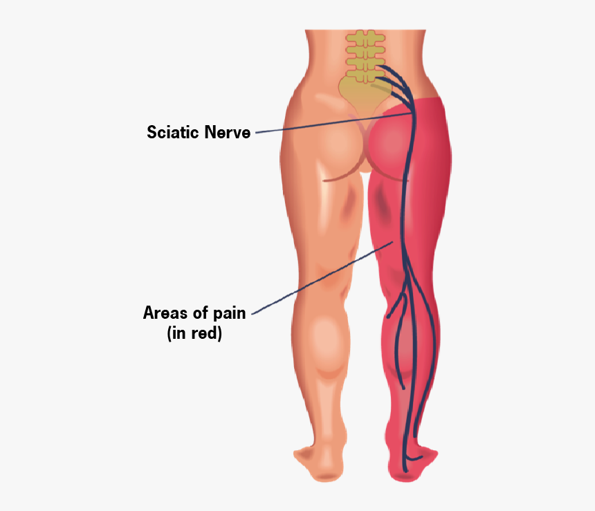 Sciatica vs. Sciatic Nerve Pain