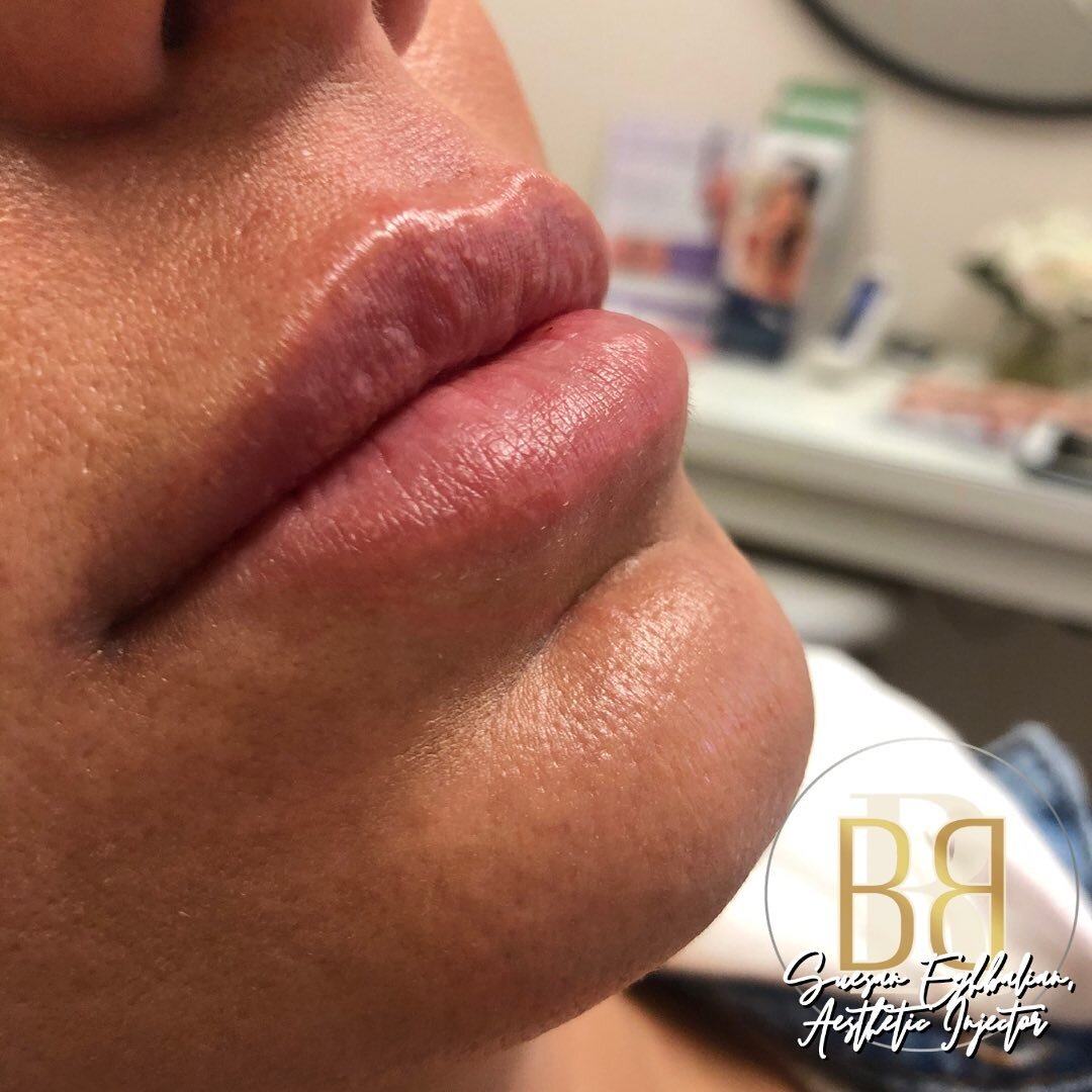 SHE&rsquo;S BACK!!!!!!!!! 🥳🥳🥳
Lips 👄 by our talented injector @suesan_aesthetics 
Used @restylaneusa Kysse for subtle hydrated lips 😘
GREAT NEWS! She is adding another day at RBB!  That means she&rsquo;ll have time for all of us 🤩🥳🤪😘😘
Welco