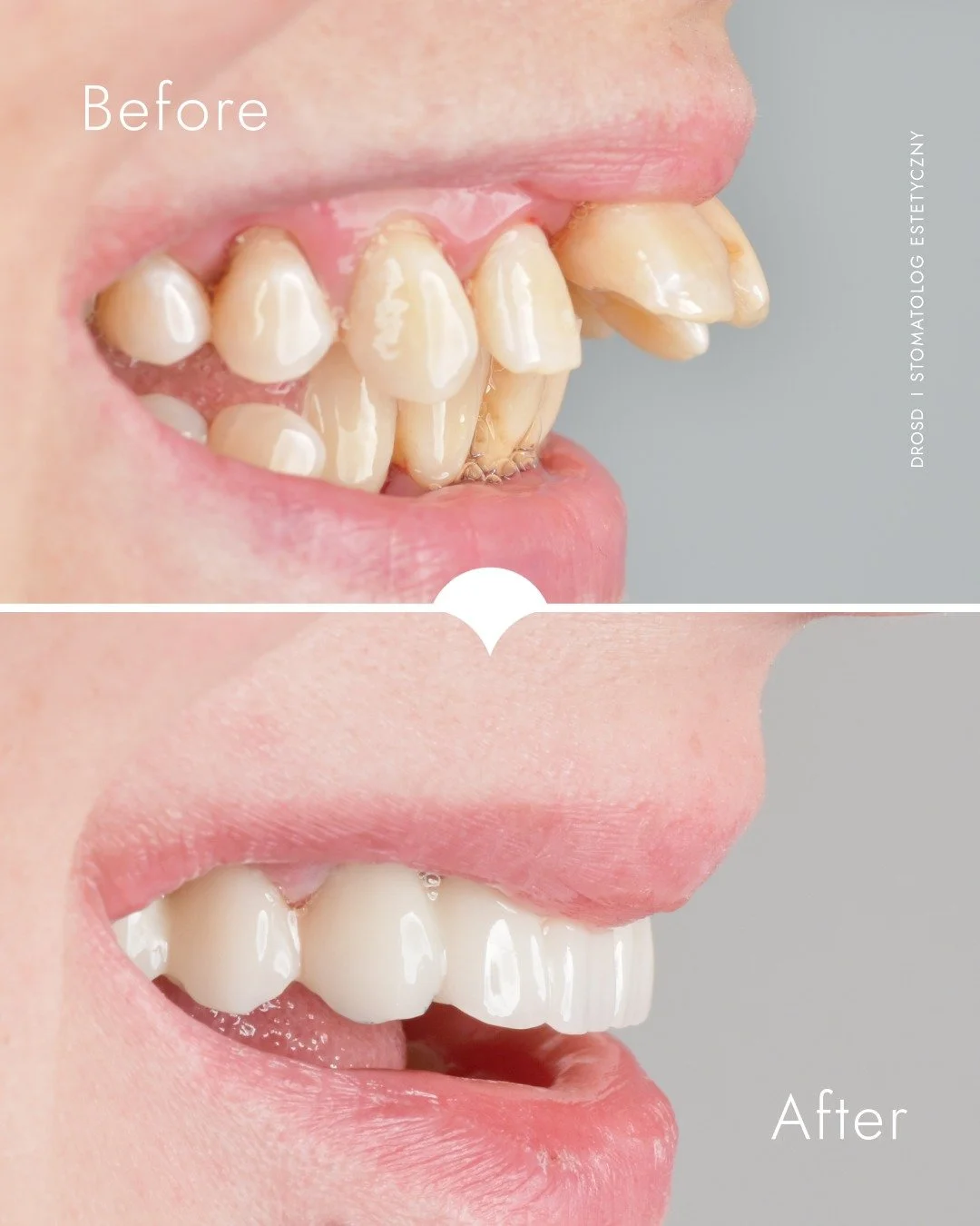 Paradontoza potrafi zmienić nie tylko uśmiech, ale też rysy twarzy.
U tej młodej pacjentki zęby wysunęły się do przodu, straciły stabilność i zaczęły się ruszać. Dziś — po wdrożeniu leczenia i założeniu pracy tymczasowej — uśmiech wygląda