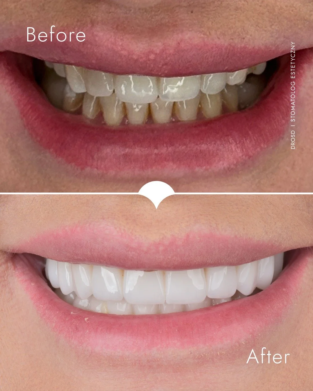 Krok przed efektem końcowym
W tej metamorfozie łuk górny zakończyłem pracami stałymi — korony pełnoceramiczne dopasowane do rysów twarzy i linii uśmiechu. Na dole zastosowałem rozwiązanie tymczasowe, aby spokojnie sprawdzić komfo