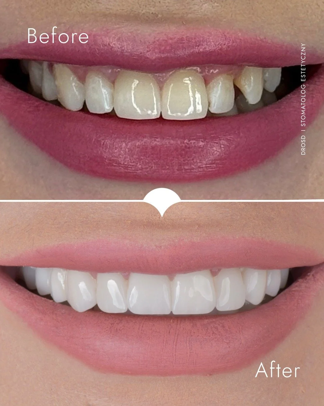 Harmonia. Symetria. Naturalność.

W tej metamorfozie zacząłem od plastyki dziąseł, aby wyr&oacute;wnać linię uśmiechu i odsłonić właściwe proporcje zęb&oacute;w. Dopiero na tak przygotowanym &bdquo;fundamencie&rdquo; zaprojektowałem pełnoceramiczną r