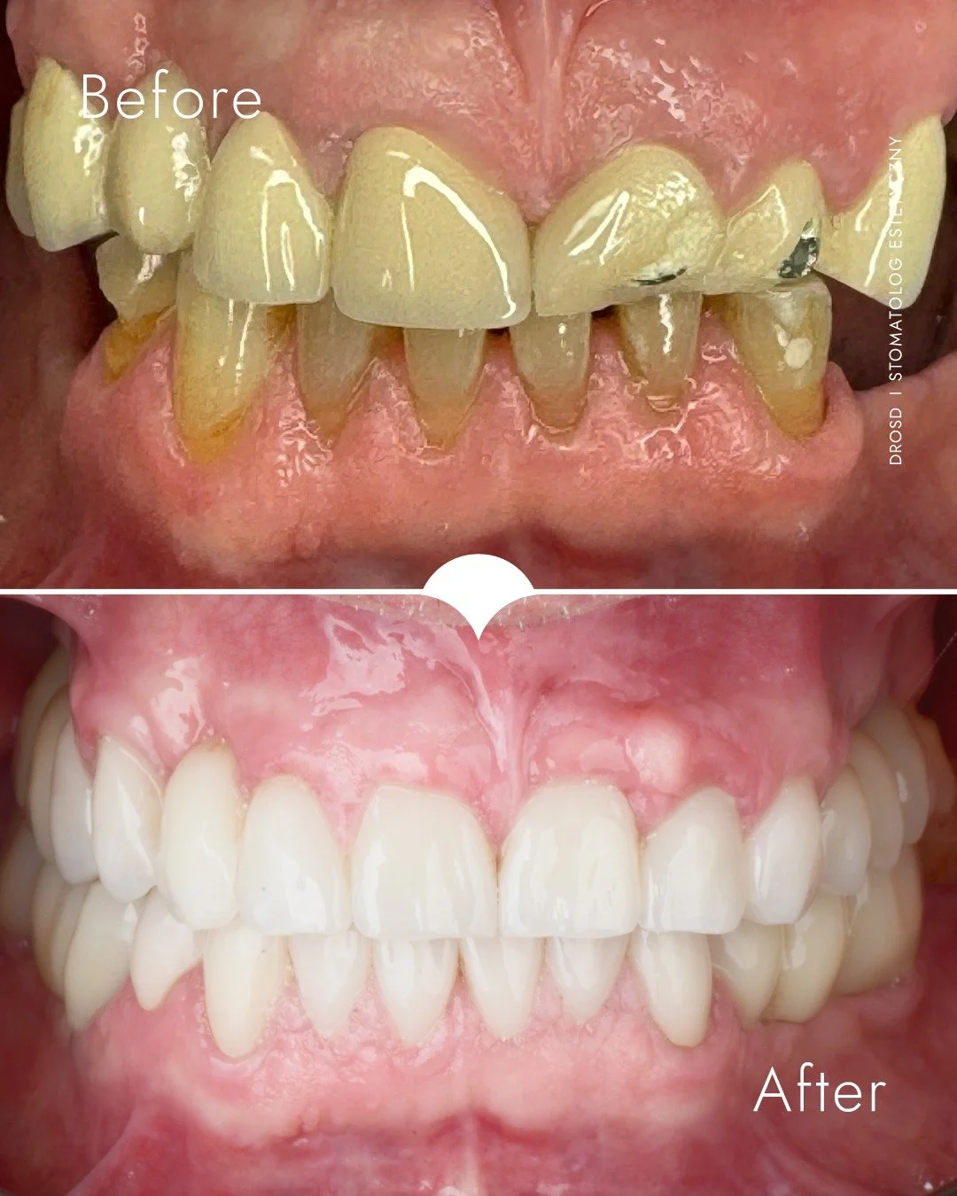 Naturalny efekt, zaprojektowany na lata

W tej metamorfozie zacząłem od chirurgicznego wydłużenia koron, by wyr&oacute;wnać linię uśmiechu i odsłonić właściwe proporcje zęb&oacute;w.
Następnie odbudowałem uzębienie przy użyciu pełnoceramicznych koron