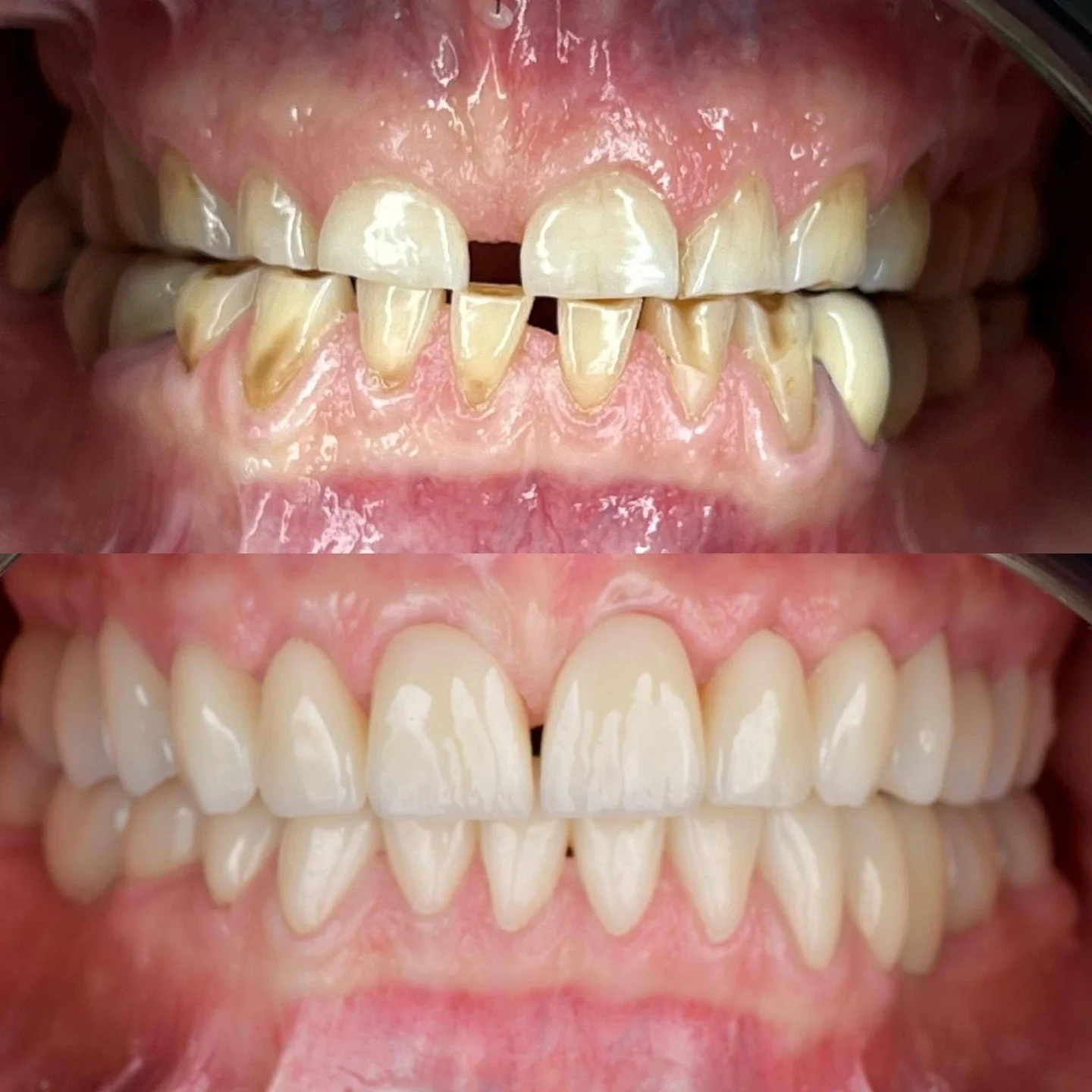 Metamorfoza uśmiechu wykonana koronami pełnoceramicznymi.

W tym przypadku zależało nam przede wszystkim na odświeżeniu koloru, wyr&oacute;wnaniu kształt&oacute;w i przywr&oacute;ceniu harmonii uśmiechu.

Zastosowanie koron pełnoceramicznych pozwolił