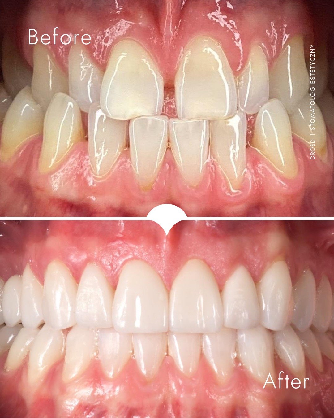 Czasem wystarczy połączenie nowoczesnych nakładek Invisalign, wybielania i lic&oacute;wek, aby odmienić uśmiech i nadać mu prawdziwą, białą świeżość na święta.

To metamorfoza, kt&oacute;ra pokazuje, jak precyzyjna ortodoncja i estetyka potrafią stwo