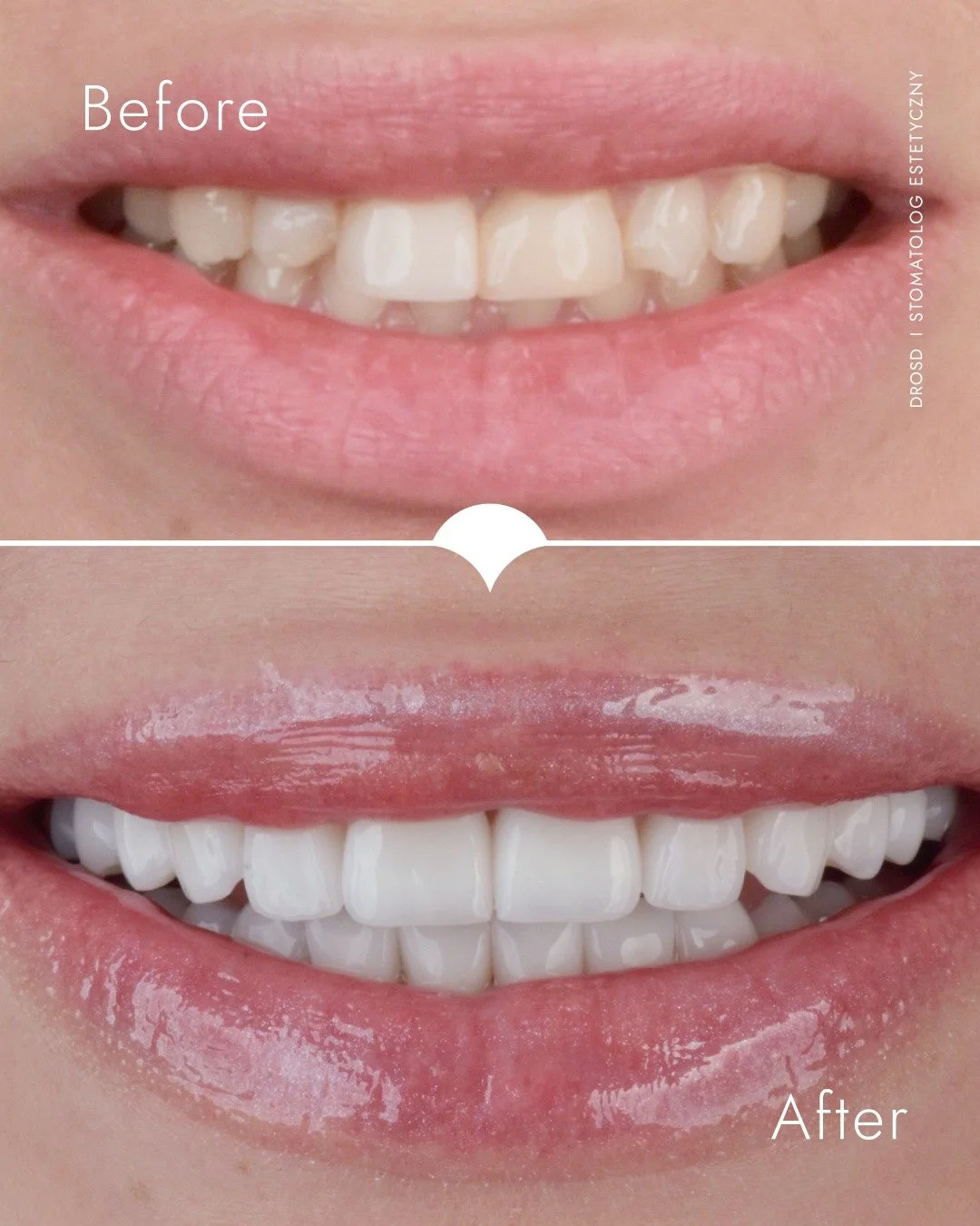 Lic&oacute;wki to temat, kt&oacute;ry regularnie pojawia się na moim profilu - to jedno z tych rozwiązań, kt&oacute;re przy dobrym planie potrafi całkowicie zmienić uśmiech, bez utraty naturalnego efektu.

Dziś zamiast kolejnych wyjaśnień i schemat&o