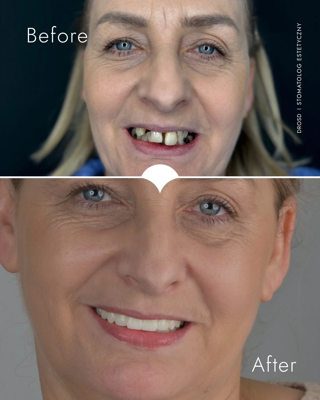 To dopiero połowa drogi &ndash; a już widać, jak bardzo zmienia się uśmiech!

To był ten moment, w kt&oacute;rym moja Pacjentka po raz pierwszy zobaczyła swoją nową, tymczasową pracę. 

Jesteśmy po ważnym etapie chirurgicznym &ndash; wszczepiliśmy 8 