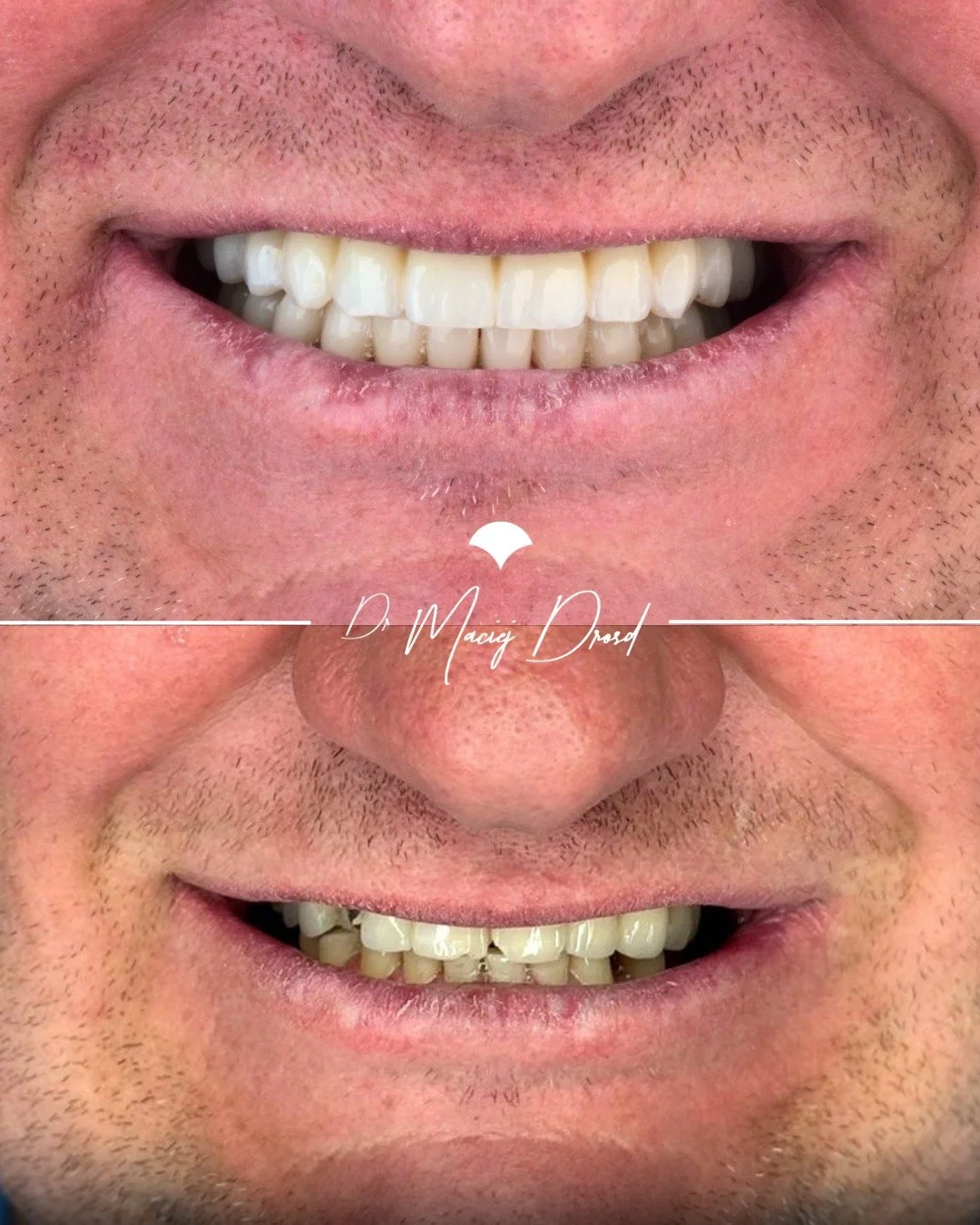 Lata mijają. A zęby &mdash; po cichu &mdash; znikają.
Nie z powodu pr&oacute;chnicy.
Nie z powodu zaniedbania.
Z powodu czegoś, czego większość ludzi nawet nie czuje.
Starcie patologiczne to cichy zab&oacute;jca uśmiechu. Działa latami &mdash; powoli