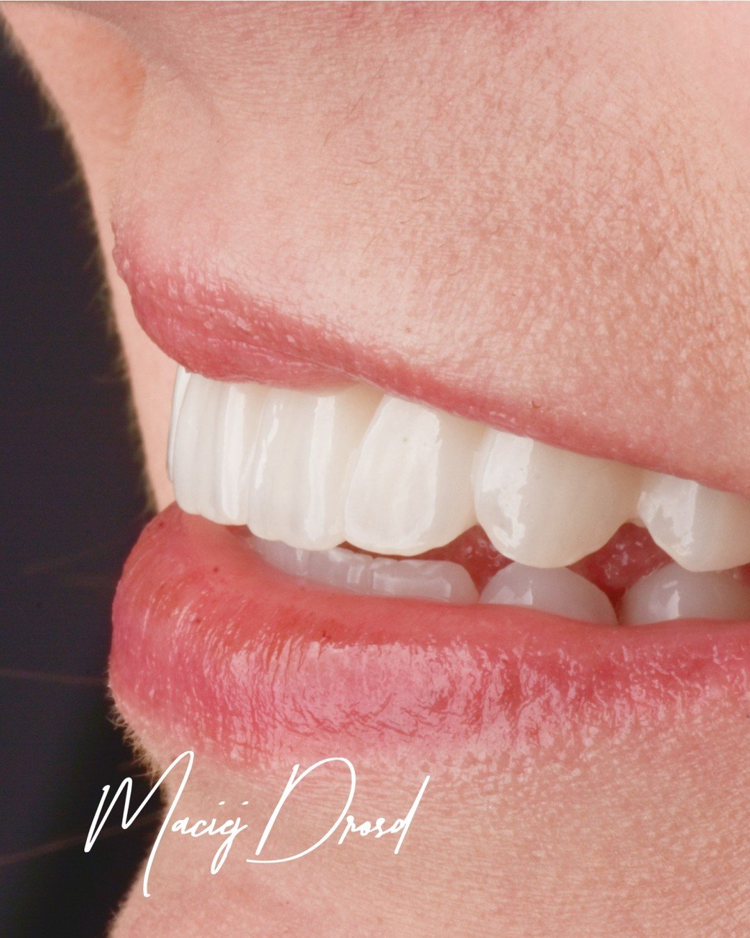 Przez lata zakrywała usta dłonią kiedy się śmiała. 

Paradontoza nie boli tylko fizycznie. Ona kradnie coś znacznie więcej &mdash; pewność siebie, radość, swobodę bycia sobą. Pani Anna wiedziała o tym aż za dobrze.

Kiedy trafiła do mojego gabinetu, 