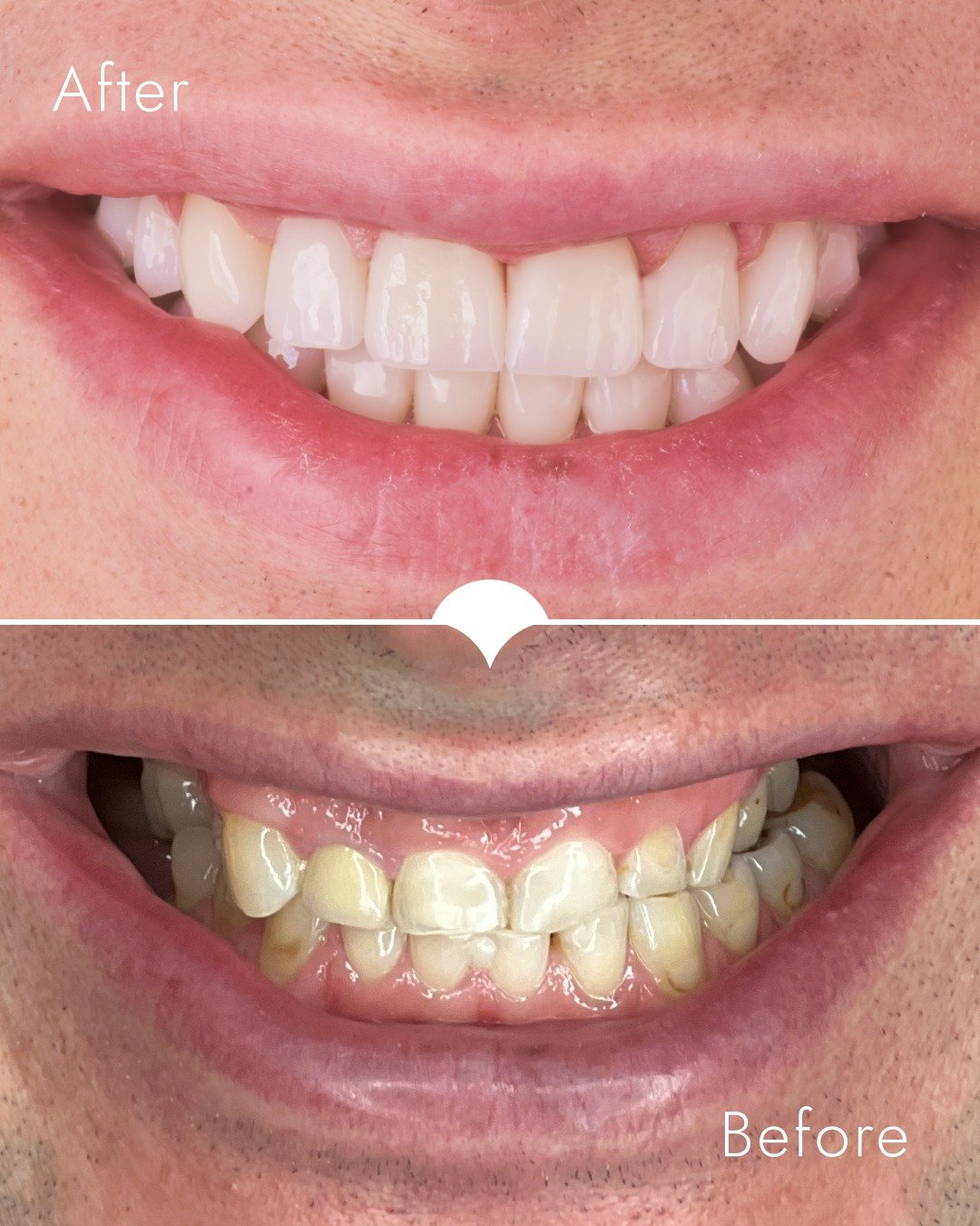 Pan Grzegorz przyszedł z trzema problemami naraz.

Trzy implanty. Invisalign na obu łukach. Lic&oacute;wki jako finał.
Większość gabinet&oacute;w rozbiłaby to na dwa lata i trzech r&oacute;żnych lekarzy. My zaplanowaliśmy wszystko sekwencyjnie, pod j