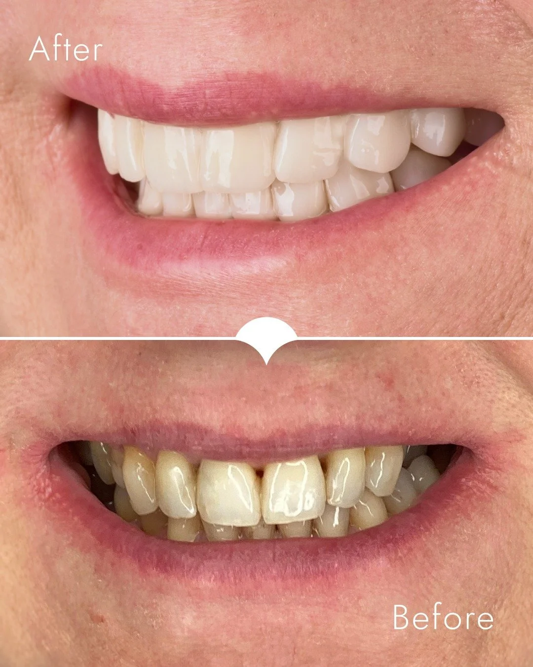 Pani Jolanta bała się aparatu przez całe życie.

Invisalign zmienił to. Żadnego metalu, żadnego wstydu. Tylko wyniki.

Po korekcie zwarcia przyszedł czas na lic&oacute;wki w obu łukach. Ortodoncja i estetyka razem, bo jedno bez drugiego to połowa rob