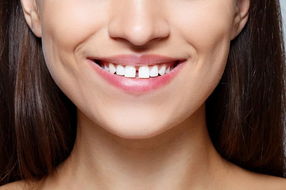 Diastema - przerwa między zębami, którą da się wyleczyć