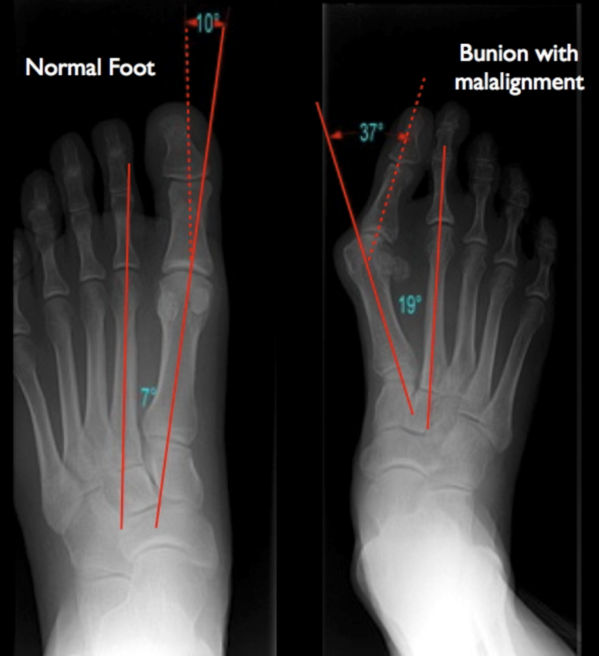 How To Manage Your Bunion — Direct Orthopedic Care