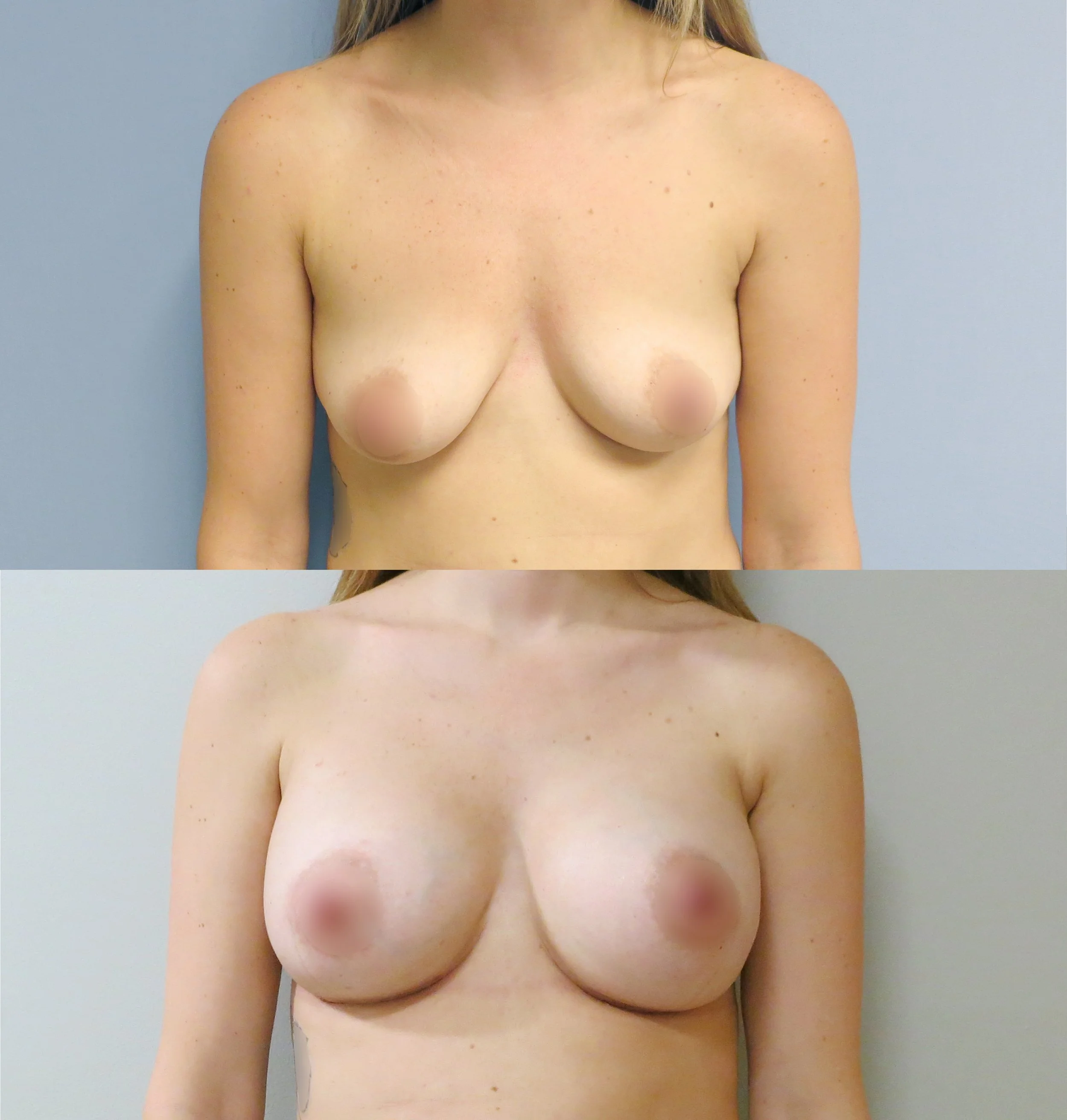 Breast Augmentation