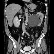 Puj Defination PUJ obstruction — Adelaide Urology Care