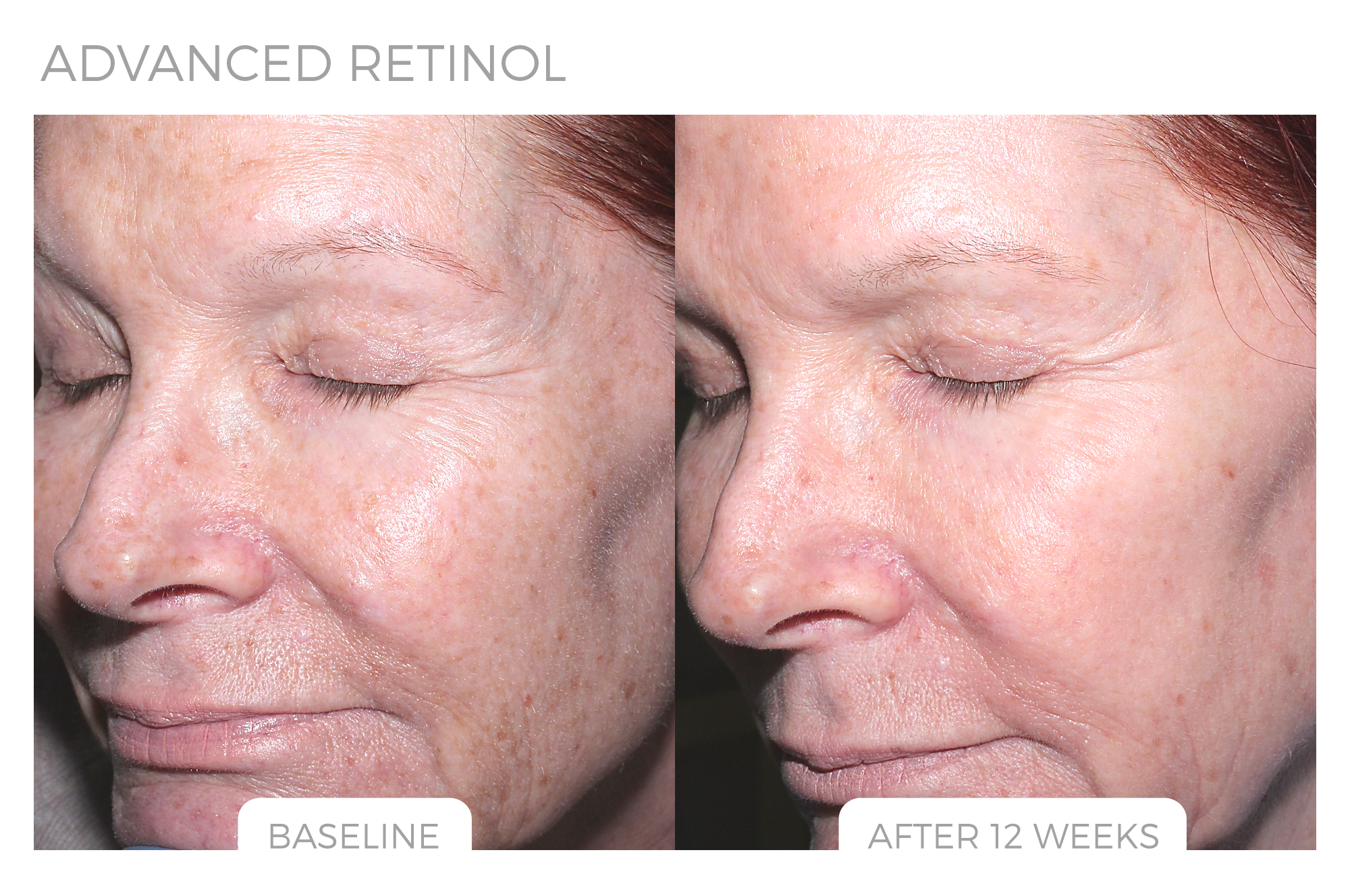 Advanced Retinol Before & After Photo 1.png