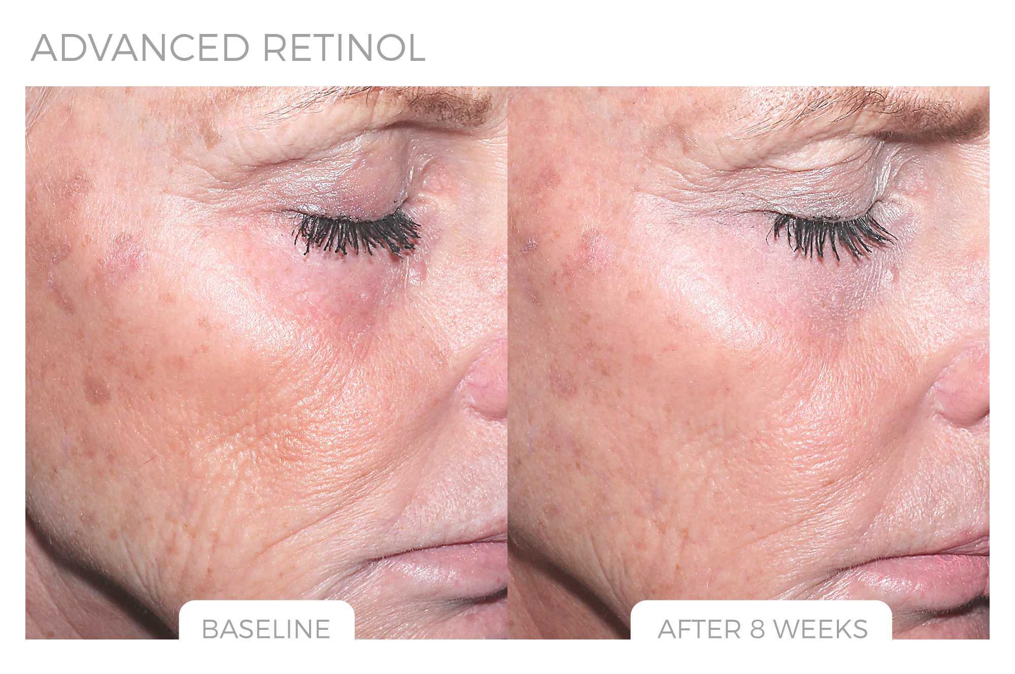 Advanced Retinol Before & After Photo 4.png