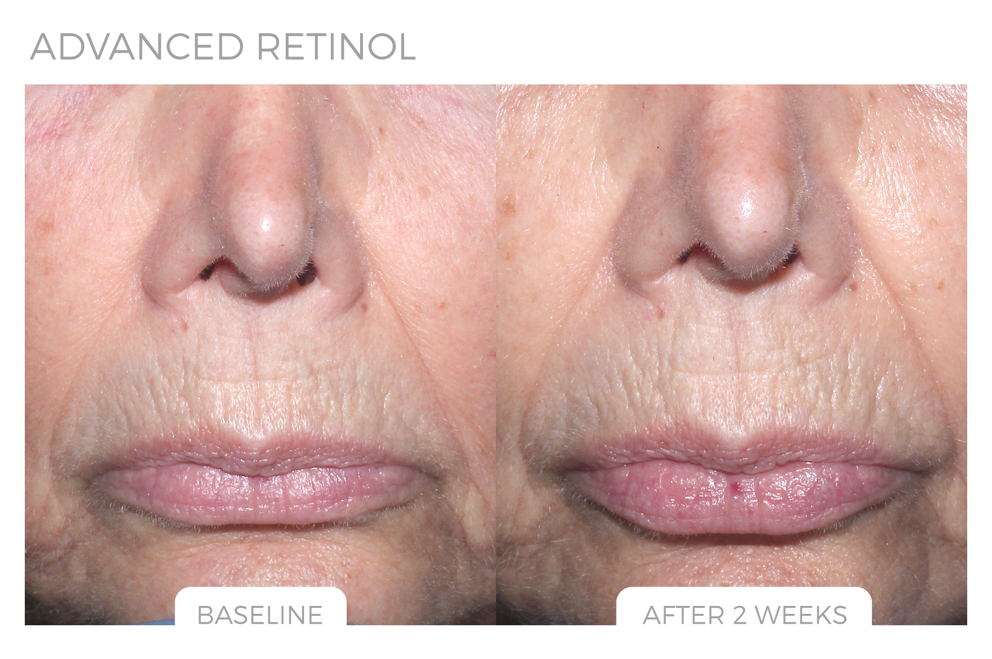 Advanced Retinol Before & After Photo 3.png