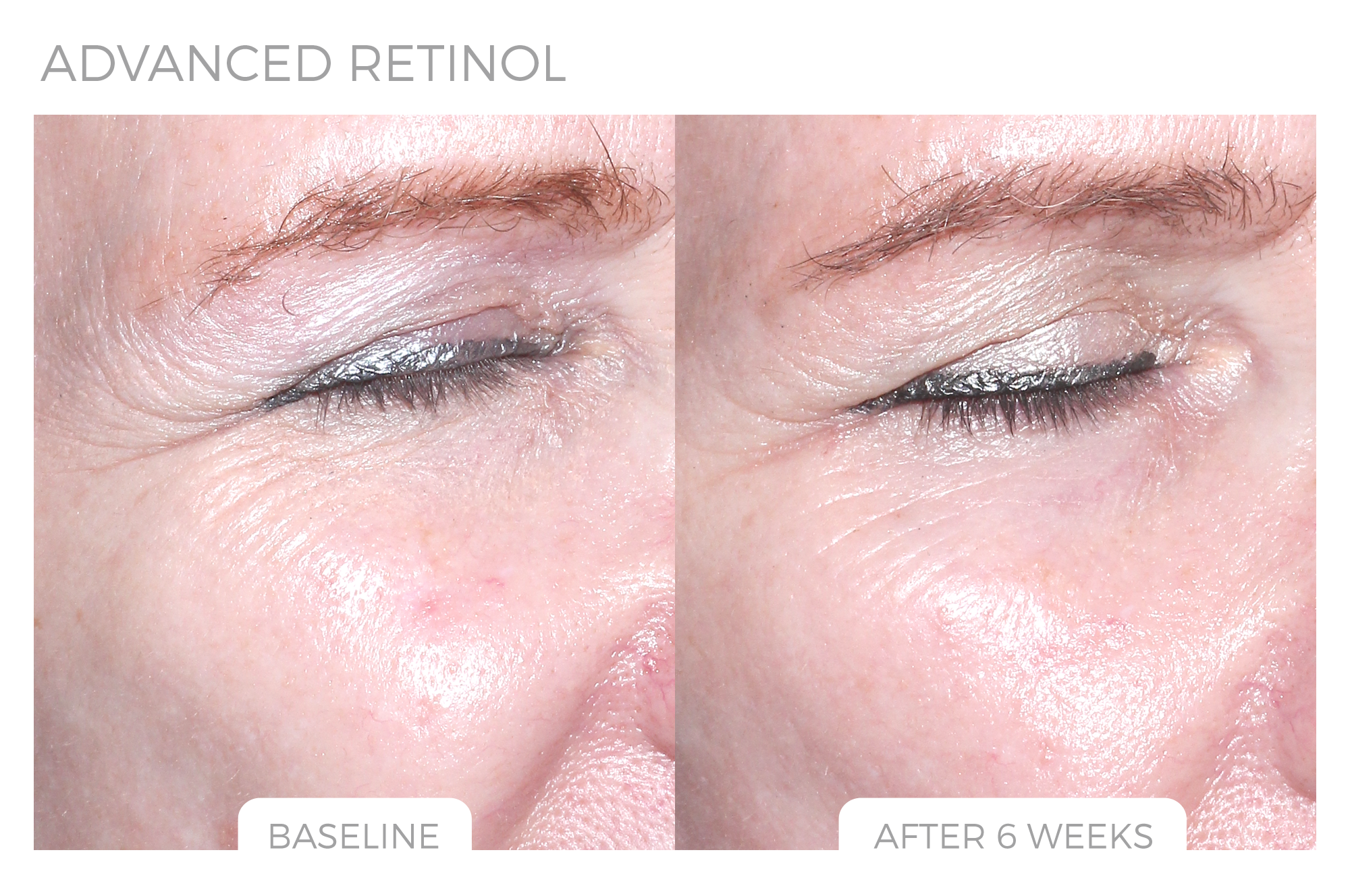 Advanced Retinol Before & After Photo 2.png